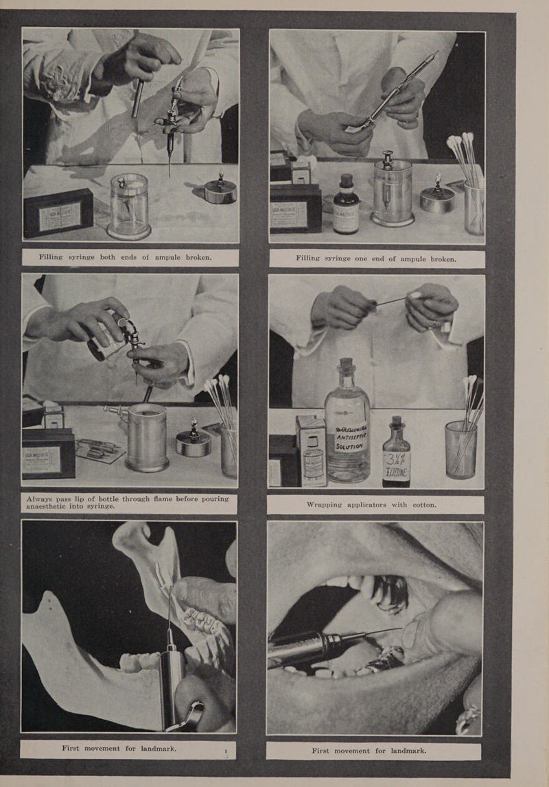 Gas po WO 5 Co Filling syringe both ends of ampule broken. &lt;7 Ce “34 wae TOONE | First movement for landmark.