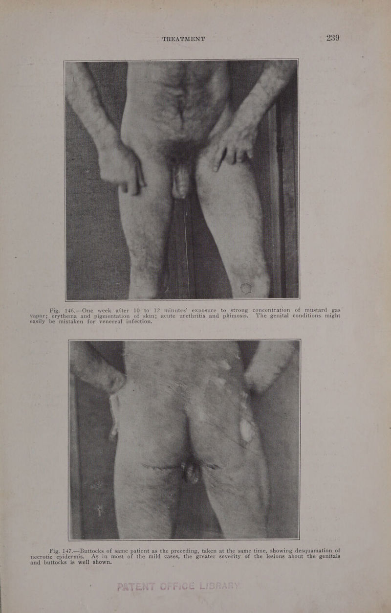 Fig. 146.—One week after 10 to 12 minutes’ exposure to strong concentration of mustard gas_ vapor; erythema and pigmentation of skin; acute urethritis and phimosis. The genital conditions might easily be mistaken for venereal infection. Fig. 147.—Buttocks of same patient as the preceding, taken at the same time, showing desquamation of necrotic epidermis. As in most of the mild cases, the greater severity of the lesions about the genitals and buttocks is well shown,