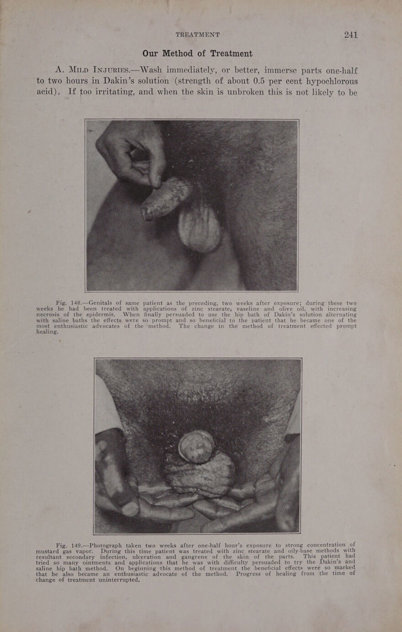— 7 TREATMENT 241 Our Method of Treatment A. Minp Inguries.—Wash immediately, or better, immerse parts one-half to two hours in Dakin’s solution (strength of about 0.5 per cent hypochlorous acid). If too irritating, and when the skin is unbroken this is not likely to be Fig. 148.—Genitals of same patient as the preceding, two weeks after exposure; during these two weeks he had been treated with applications of zinc stearate; vaseline and olive oil, with increasing necrosis of the epidermis. When finally persuaded to use the hip bath of Dakin’s solution alternating with saline baths the effects were so prompt and so beneficial to the patient that he became one of the most enthusiastic advocates of the ‘method. ‘The change in the method of treatment effected prompt healing. Fig. 149.—Photograph taken two weeks after one-half hour’s exposure to strong concentration of mustard gas vapor. During this time patient was treated with zinc stearate and oily-base methods with resultant secondary infection, ulceration and gangrene of the skin of the parts. ‘This patient had tried so many ointments and applications that he was with difficulty persuaded to try the Dakin’s and saline hip bath method. On beginning this method of treatment the beneficial effects were so marked that he also became an enthusiastic advocate of the method. Progress of healing from the time of change of treatment uninterrupted,