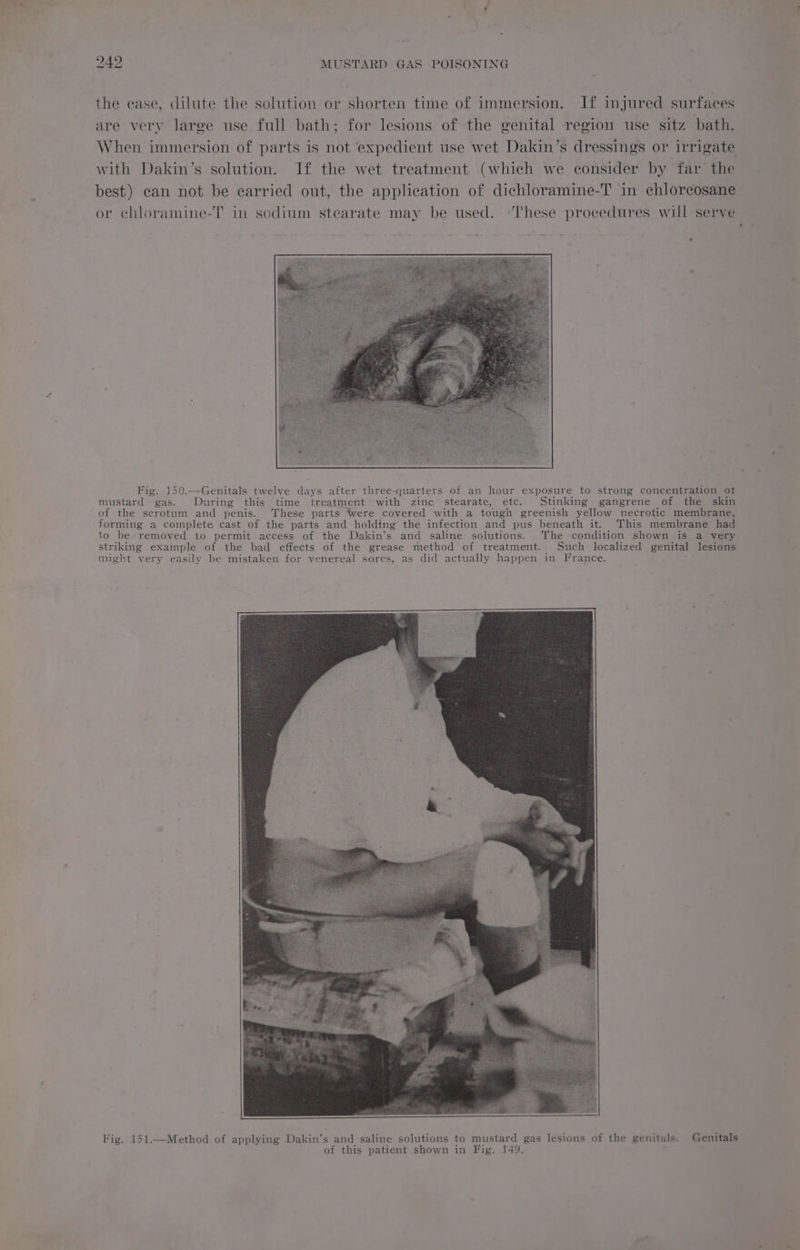 the ease, dilute the solution or shorten time of immersion. If injured surfaces are very large use full bath; for lesions of the genital region use sitz bath. When immersion of parts is not expedient use wet Dakin’s dressings or irrigate with Dakin’s solution. If the wet treatment (which we consider by far the best) can not be carried out, the application of dichloramine-T in chlorcosane or chloramine-T in sodium stearate may be used. ‘T'hese procedures will serve Fig. 150.—Genitals twelve days after three-quarters of an hour exposure to strong concentration ot mustard gas. During this time treatment with zinc stearate, etc. Stinking gangrene of the skin of the scrotum and penis. ‘These parts Were covered with a tough greenish yellow necrotic membrane, forming a complete cast of the parts and holding the infection and pus beneath it. This membrane had to be removed to permit access of the Dakin’s and saline solutions. The condition shown is a very striking example of the bad effects of the grease method of treatment. Such localized genital lesions might very easily be mistaken for venereal sores, as did actually happen in France. Fig. 151.—Method of applying Dakin’s and saline solutions to mustard gas lesions of the genitals. Genitals of this patient shown in Fig. 149, i.