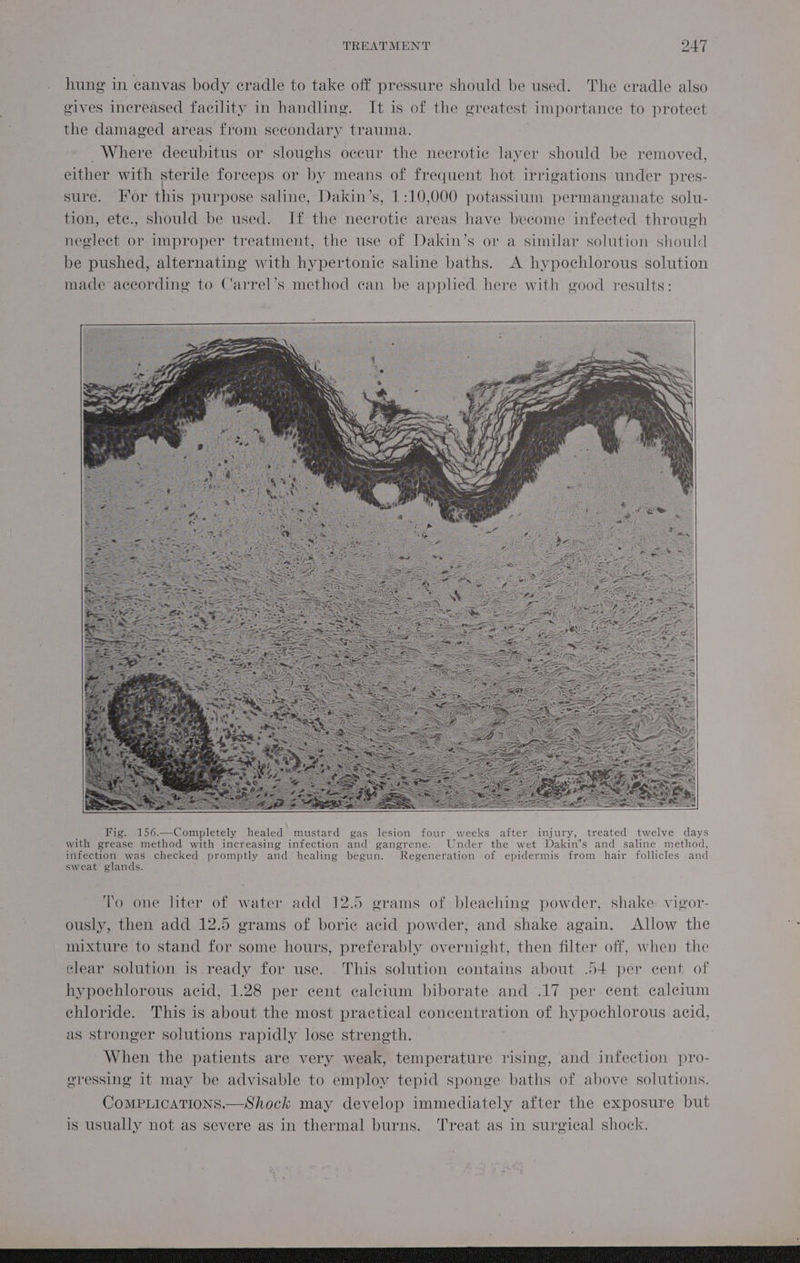 hung in canvas body cradle to take off pressure should be used. The cradle also gives increased facility in handling. It is of the greatest importance to protect the damaged areas from secondary trauma. Where decubitus or sloughs occur the necrotic layer should be removed, either with sterile forceps or by means of frequent hot irrigations under pres- sure. Hor this purpose saline, Dakin’s, 1:10,000 potassium permanganate solu- tion, ete., should be used. If the necrotic areas have beeome infected through neglect or improper treatment, the use of Dakin’s or a similar solution should be pushed, alternating with hypertonic saline baths. A hypochlorous solution made according to Carrel’s method can be applied here with good results: Fig. 156.—Completely healed mustard gas lesion four weeks after injury, treated twelve days with grease method with increasing infection and gangrene. Under the wet Dakin’s and saline method, infection was checked promptly and healing begun. Regeneration of epidermis from hair follicles and sweat glands. To one liter of water add 12.5 grams of bleaching powder, shake. vigor- ously, then add 12.5 grams of boric acid powder, and shake again. Allow the mixture to stand for some hours, preferably overnight, then filter off, when the clear solution is.ready for use. This solution contains about .54 per cent of hypochlorous acid, 1.28 per cent calcium biborate and .17 per cent calcium chloride. This is about the most practical concentration of hypochlorous acid, as stronger solutions rapidly lose strength. When the patients are very weak, temperature rising, and infection pro- eressing it may be advisable to employ tepid sponge baths of above solutions. CoMPLICATIONS.—Shock may develop immediately after the exposure but is usually not as severe as in thermal burns. Treat as in surgical shock.