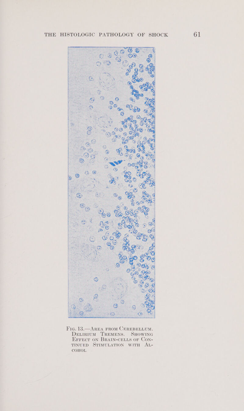 Fig. 13.—AREA FROM CEREBELLUM. DeELIRIUM TREMENS. SHOWING EFFECT ON BRAIN-CELLS OF Con- TINUED STIMULATION wITH AL- COHOL.