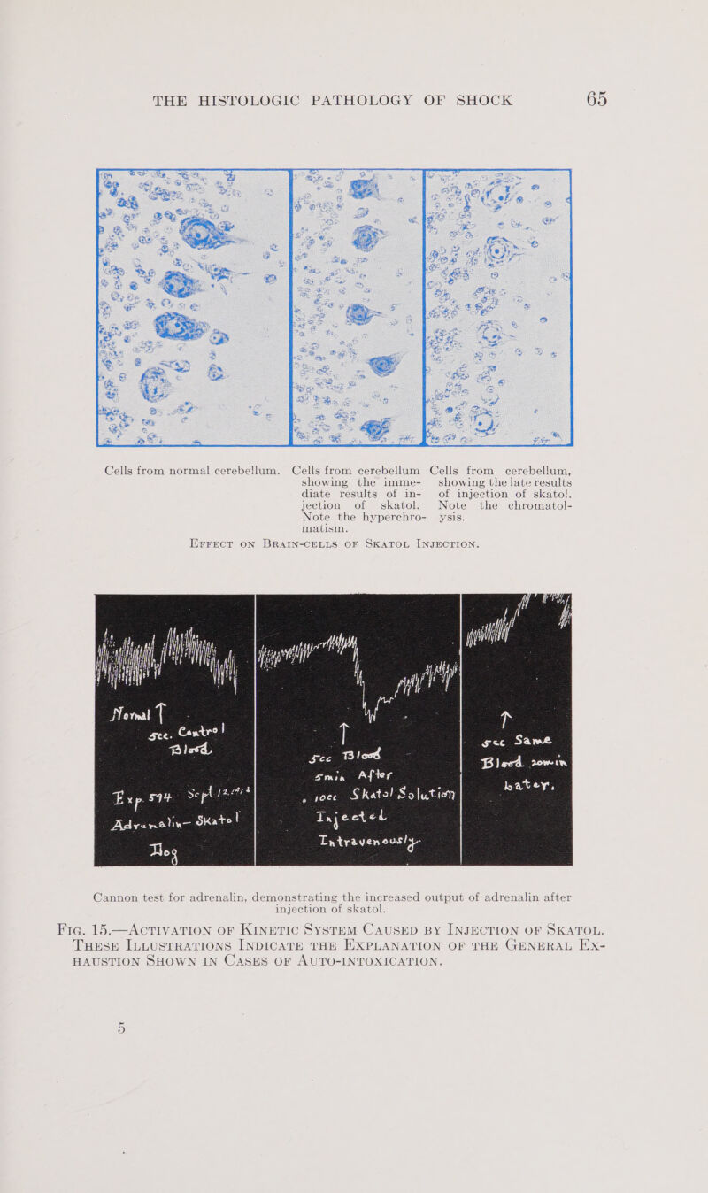 Cells from normal cerebellum. Cells from cerebellum Cells from cerebellum, showing the imme- showing the late results diate results of in- of injection of skatol. jection of skatol. Note the chromatol- Note the hyperchro- ysis. matism. EFrrect oN BRAIN-CELLS OF SKATOL INJECTION. age ee i fi! i i f* vd | JNornal t : see. Contr? : 2 B! pee Blood Exp 5qy Sepl see , yoee Skate! Solution Adrenelin- SKato y : Tajeeted Cannon test for adrenalin, demonstrating the increased output of adrenalin after injection of skatol. HAUSTION SHOWN IN CASES OF AUTO-INTOXICATION.