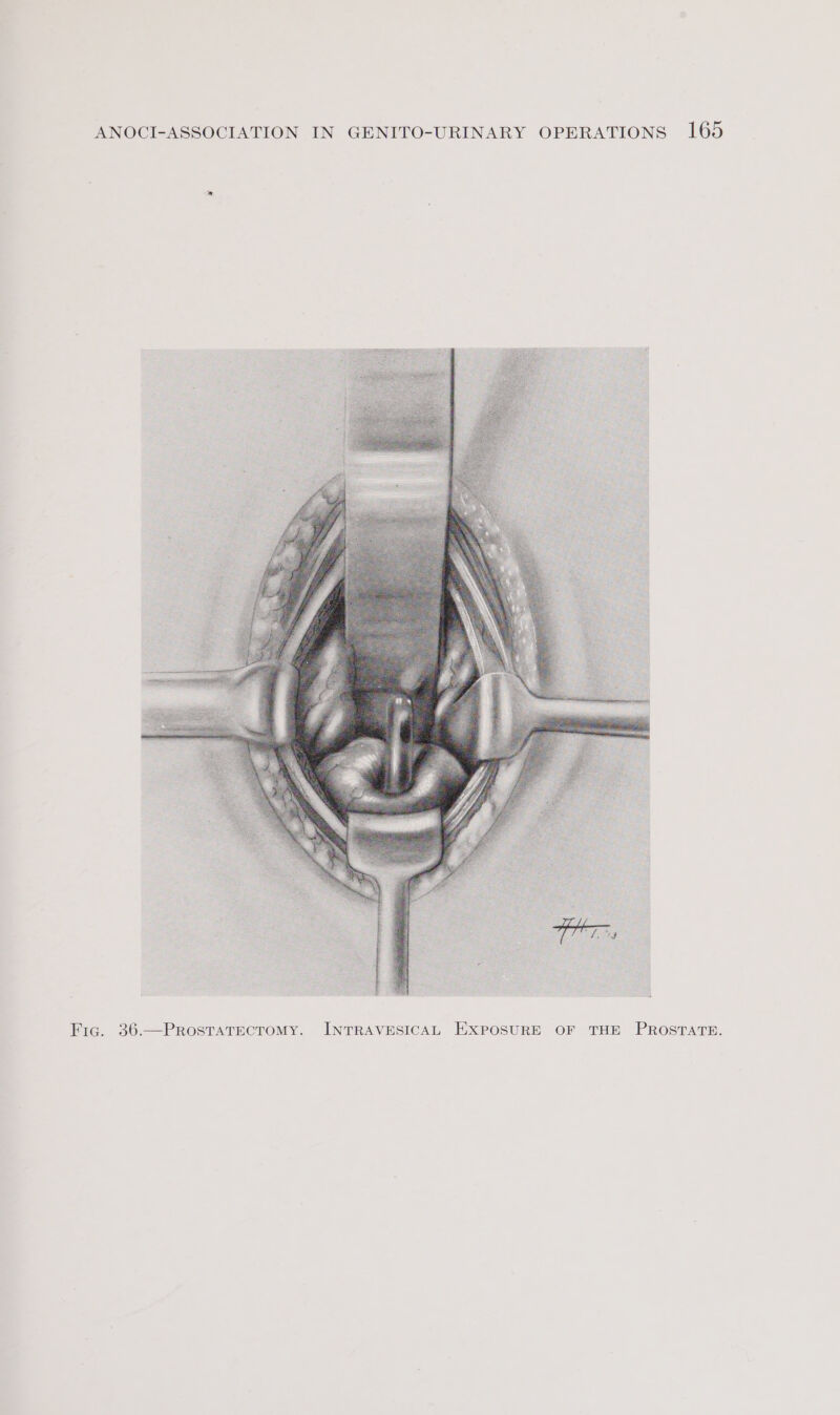 Fic. 36.—PROSTATECTOMY. INTRAVESICAL EXPOSURE OF THE PROSTATE.