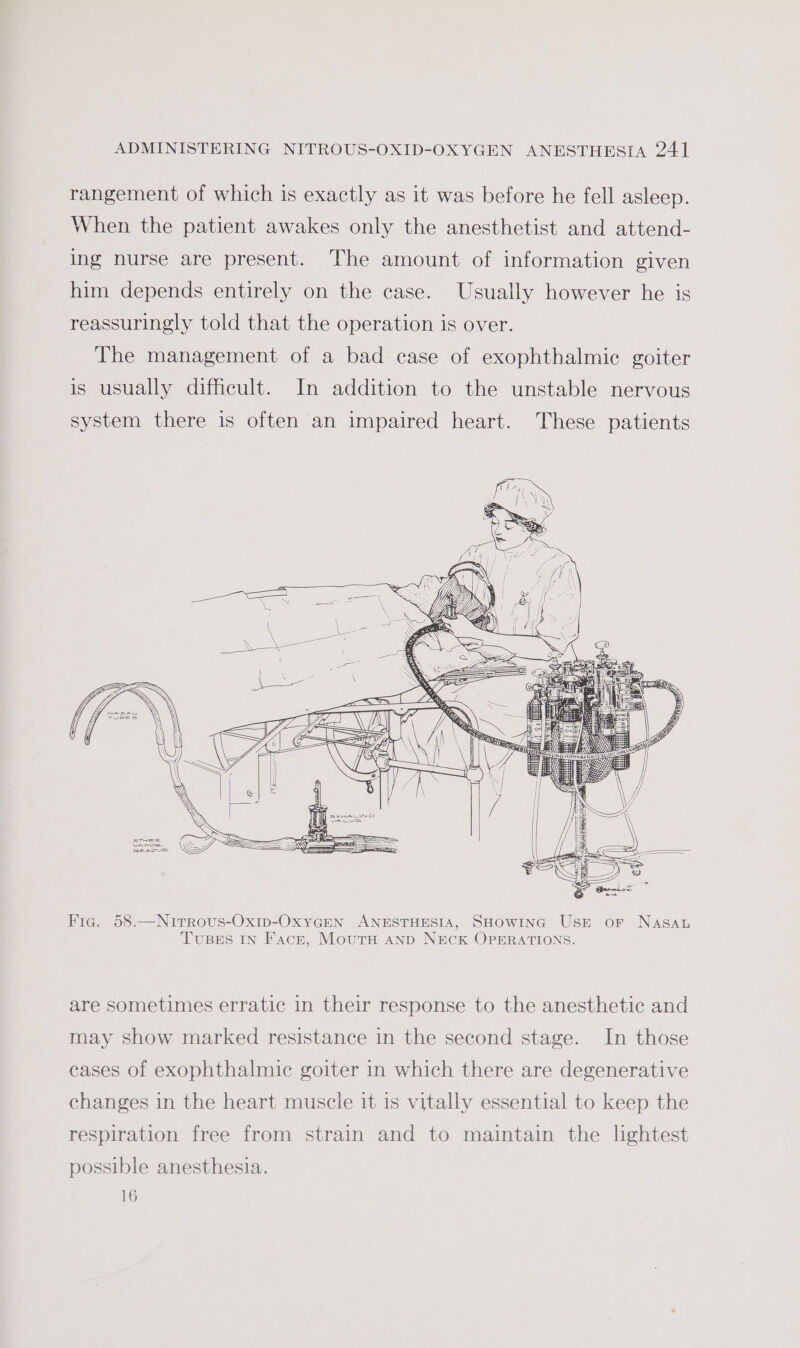 rangement of which is exactly as it was before he fell asleep. When the patient awakes only the anesthetist and attend- ing nurse are present. The amount of information given him depends entirely on the case. Usually however he is reassuringly told that the operation is over. The management of a bad case of exophthalmic goiter is usually difficult. In addition to the unstable nervous Fig. 58.—Nrirrous-Oxip-OxyGEN ANESTHESIA, SHowrnc Use or Nasa TuBEs IN Face, MoutH anp N&amp;ecK OPERATIONS. are sometimes erratic in their response to the anesthetic and may show marked resistance in the second stage. In those cases of exophthalmic goiter in which there are degenerative changes in the heart muscle it is vitally essential to keep the respiration free from strain and to maintain the lghtest possible anesthesia. 16