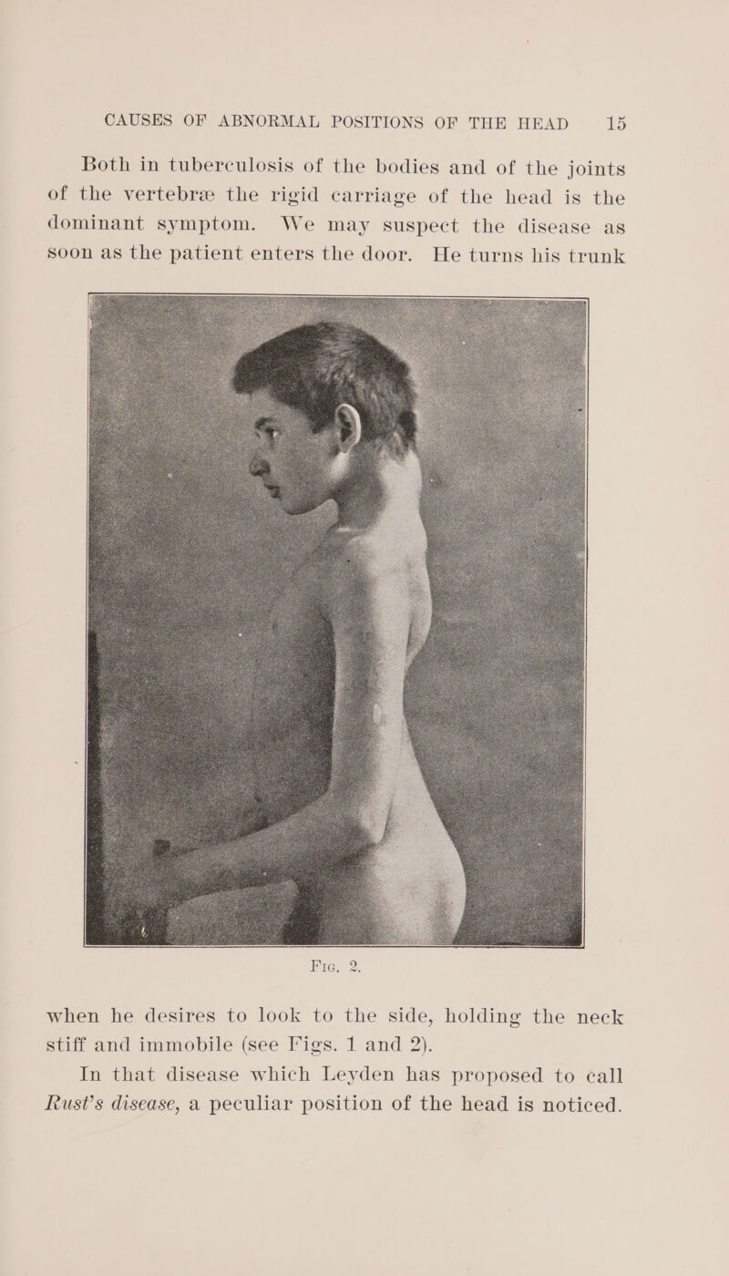 Both in tuberculosis of the bodies and of the joints of the vertebre the rigid carriage of the head is the dominant symptom. We may suspect the disease as trunk soon as the patient enters the door. He turns hi when he desires to look to the side, holding the neck stiff and immobile (see I*igs. 1 and 2). In that disease which Leyden has proposed to eall Rust’s disease, a peculiar position of the head is noticed.