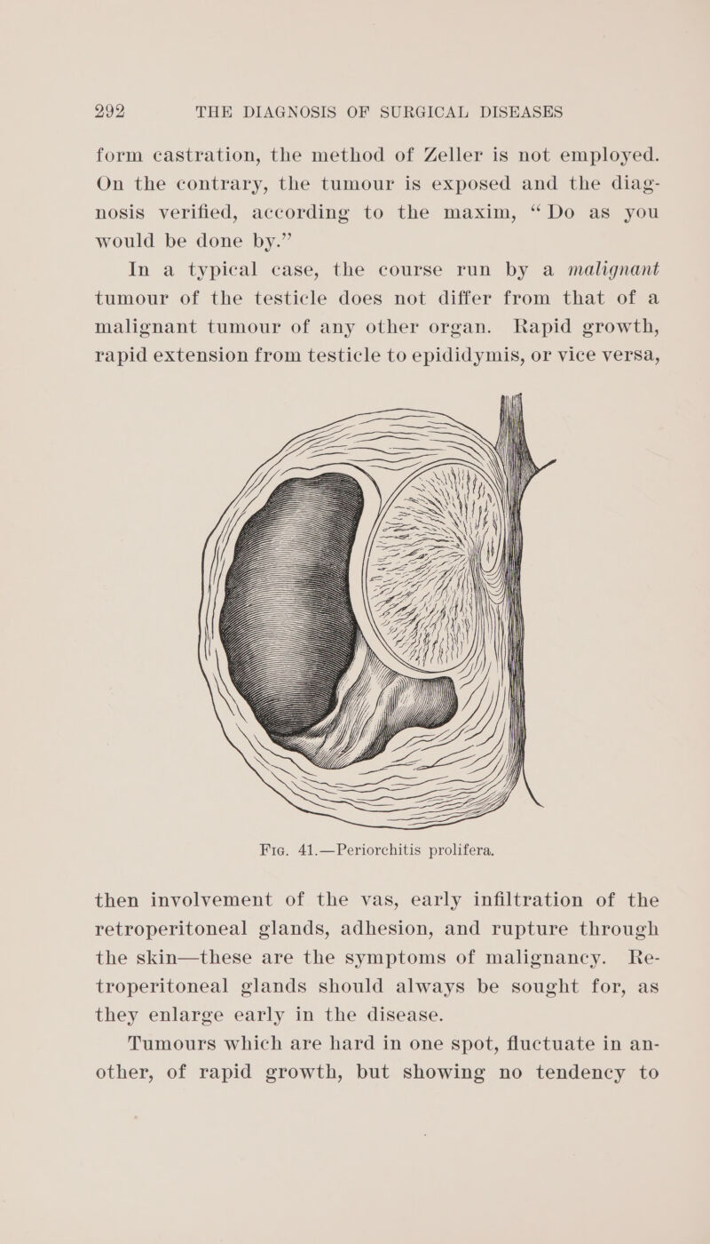 form castration, the method of Zeller is not employed. On the contrary, the tumour is exposed and the diag- nosis verified, according to the maxim, “ Do as you would be done by.” In a typical case, the course run by a malignant tumour of the testicle does not differ from that of a malignant tumour of any other organ. Rapid growth, rapid extension from testicle to epididymis, or vice versa, then involvement of the vas, early infiltration of the retroperitoneal glands, adhesion, and rupture through the skin—these are the symptoms of malignancy. Re- troperitoneal glands should always be sought for, as they enlarge early in the disease. Tumours which are hard in one spot, fluctuate in an- other, of rapid growth, but showing no tendency to