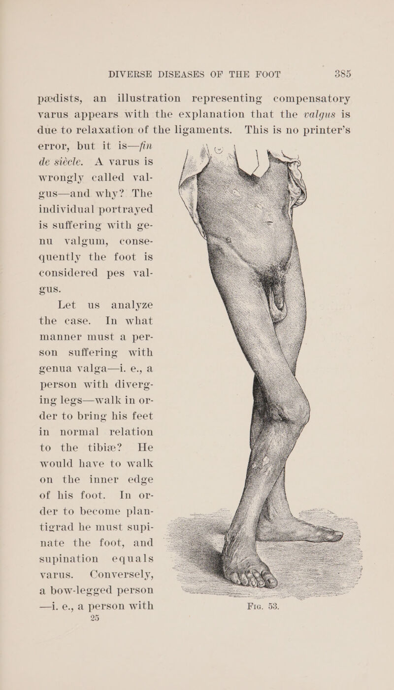 pedists, an illustration representing compensatory varus appears with the explanation that the valgus is due to relaxation of the ligaments. This is no printer’s error, but it is—fin de siécle. A varus is wrongly called val- gus—and. why? The individual portrayed is suffering with ge- nu valgum, conse- quently the foot is considered pes val- gus. Let us analyze the ease, In what manner must a per- son suffering with enw, valga—1..€:, 2 person with diverg- ing legs—walk in or- der to bring his feet in normal relation to -the vtibiey:. He would have to walk on the inner edge or tis foot.. -In or- der to become plan- tigrad he must supi- nate the foot, and supination equals varus. Conversely, a bow-legged person —i.e., a person with Fie. 53. 25