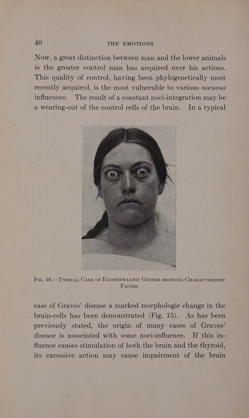 Now, a great distinction between man and the lower animals is the greater control man has acquired over his actions. This quality of control, having been phylogenetically most recently acquired, is the most vulnerable to various nocuous influences. The result of a constant noci-integration may be a wearing-out of the control cells of the brain. In a typical i | Fic. 16.—Typicaut CASE oF EXOPHTHALMIC GOITER SHOWING CHARACTERISTIC FACIES. case of Graves’ disease a marked morphologic change in the brain-cells has been demonstrated (Fig. 15). As has been previously stated, the origin of many cases of Graves’ disease is associated with some noci-influence. If this in- fluence causes stimulation of both the brain and the thyroid, its excessive action may cause impairment of the brain
