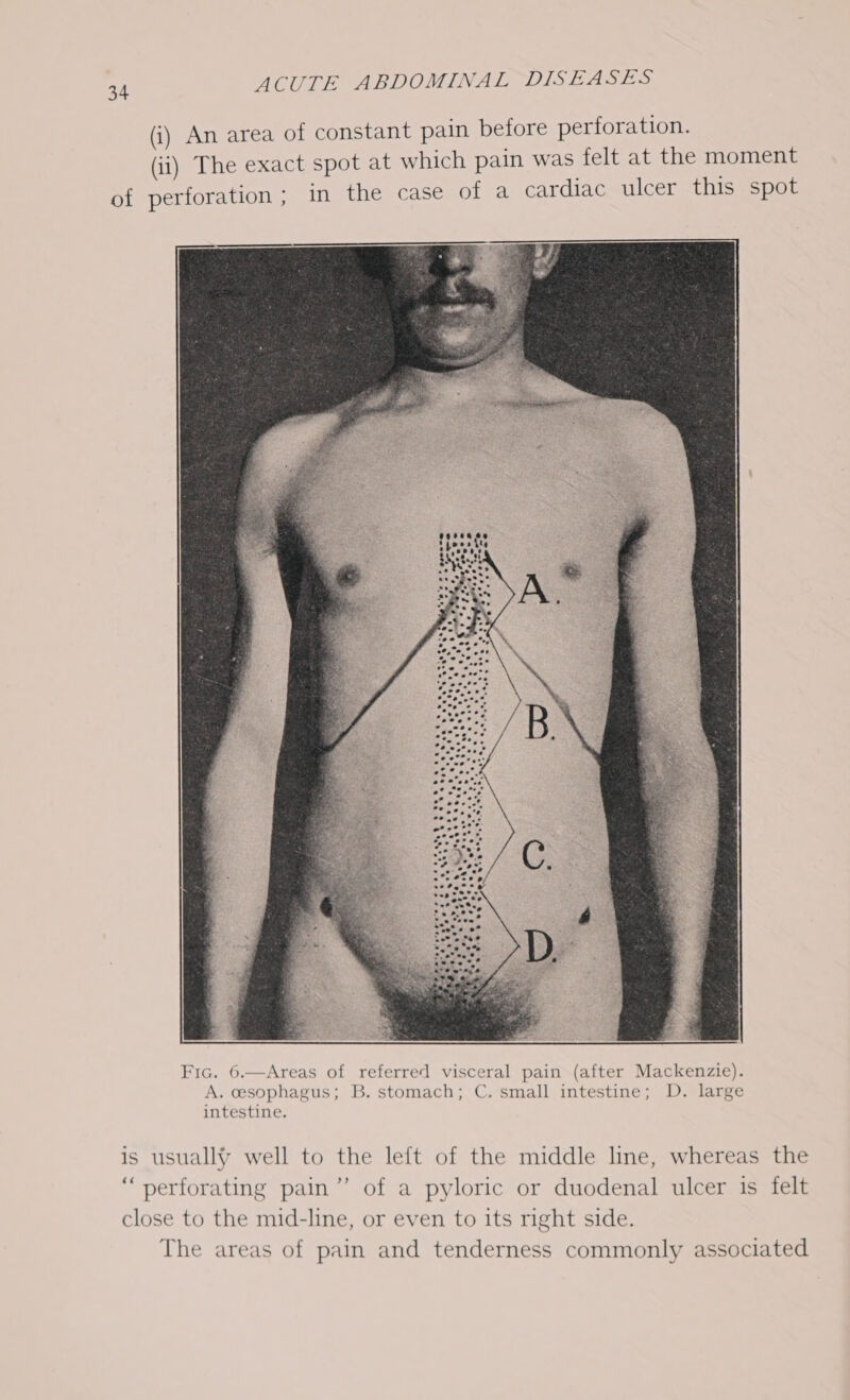 (i) An area of constant pain before perforation. (ii) The exact spot at which pain was felt at the moment of perforation; in the case of a cardiac ulcer this spot is usually well to the left of the middle line, whereas the “ perforating pain’’ of a pyloric or duodenal ulcer is felt close to the mid-line, or even to its right side. The areas of pain and tenderness commonly associated