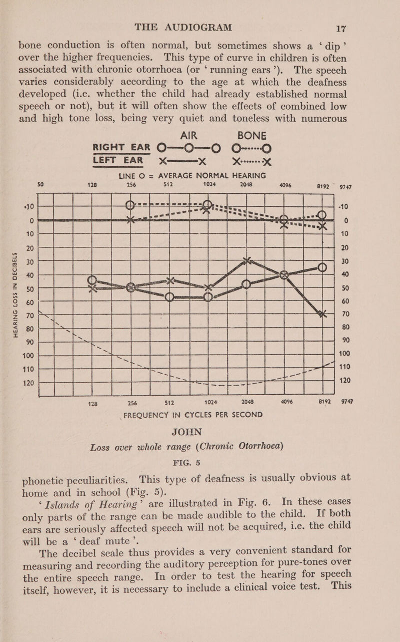 bone conduction is often normal, but sometimes shows a ‘dip’ over the higher frequencies. This type of curve in children is often associated with chronic otorrhoea (or ‘running ears’). The speech varies considerably according to the age at which the deafness developed (i.e. whether the child had already established normal speech or not), but it will often show the effects of combined low and high tone loss, being very quiet and toneless with numerous RIGHT EAR O—O—O O-----0) LEFT EAR xX x Keren dg 50 428 256 $12 1024 2048 4096 8192 ~ 9747 -10 0 10 20 30 90 128 256 $12 1024 2048 4096 8192 9747 FREQUENCY IN CYCLES PER SECOND JOHN Loss over whole range (Chronic Otorrhoea) FIG. 5 phonetic peculiarities. This type of deafness is usually obvious at home and in school (Fig. 5). ‘Islands of Hearing’ are illustrated in Fig. 6. In these cases only parts of the range can be made audible to the child. If both ears are seriously affected speech will not be acquired, i.e. the child will be a ‘deaf mute’. The decibel scale thus provides a very convenient standard for measuring and recording the auditory perception for pure-tones over the entire speech range. In order to test the hearing for speech itself, however, it is necessary to include a clinical voice test. This