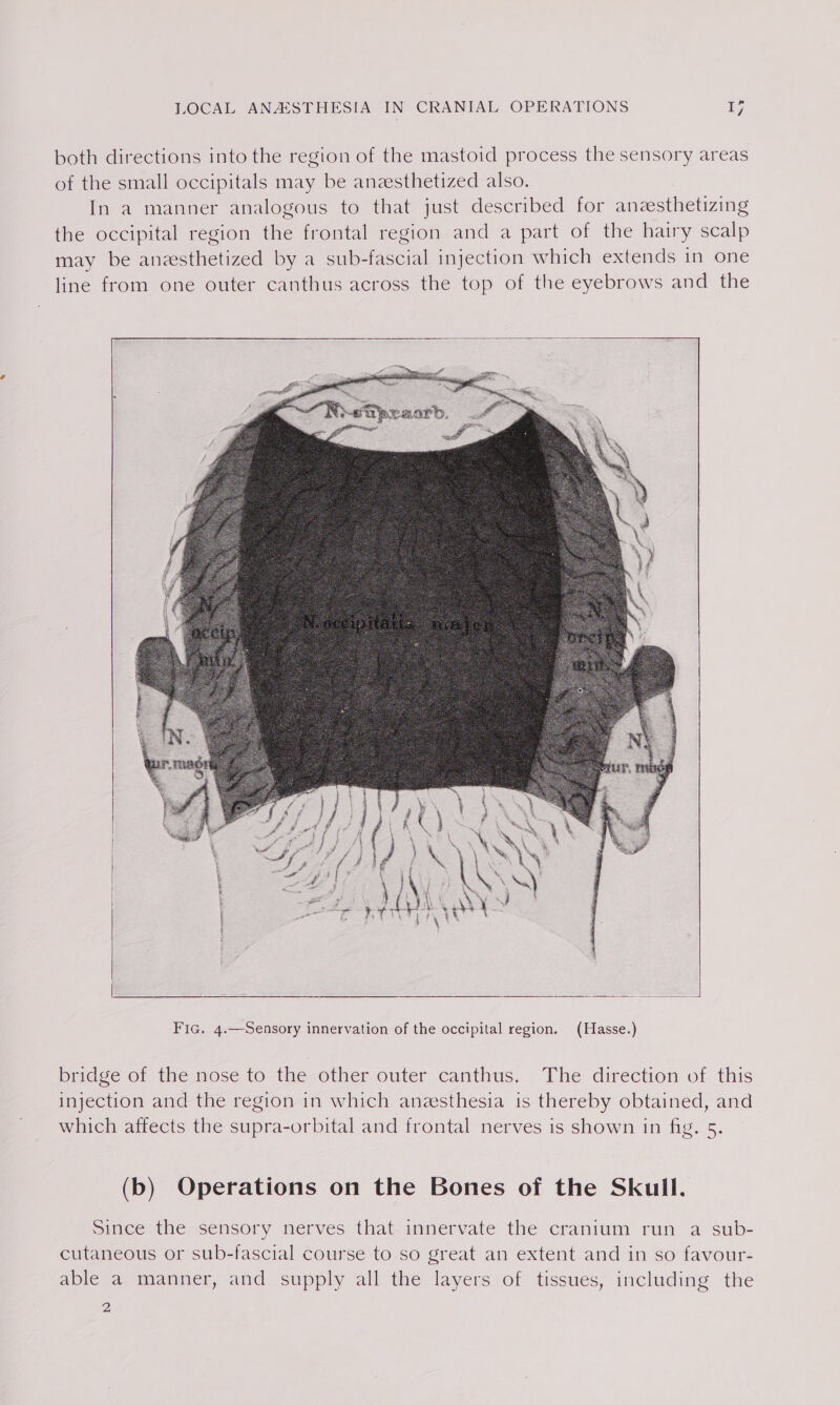 both directions into the region of the mastoid process the sensory areas of the small occipitals may be anzesthetized also. In a manner analogous to that just described for anzsthetizing the occipital region the frontal region and a part of the hairy scalp may be anzsthetized by a sub-fascial injection which extends in one line from one outer canthus across the top of the eyebrows and the bridge of the nose to the other outer canthus. The direction of this injection and the region in which anesthesia is thereby obtained, and which affects the supra-orbital and frontal nerves is shown in fig. 5. (b) Operations on the Bones of the Skull. Since the sensory nerves that innervate the cranium run a sub- cutaneous or sub-fascial course to so great an extent and in so favour- able a manner, and supply all the layers of tissues, including the