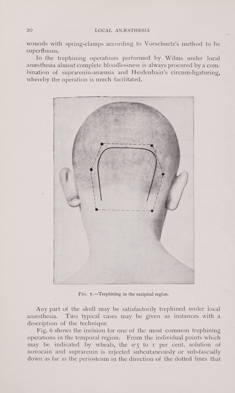 wounds with spring-clamps according to Vorschuetz’s method to be superfluous. In the trephining operations performed by Wilms under local anaesthesia almost complete bloodlessness is always procured by a com- bination of suprarenin-anemia and Heidenhain’s circum-ligaturing, whereby the operation is much facilitated. Any part of the skull may be satisfactorily trephined under local aneesthesia. Two typical cases may be given as instances with a description of the technique. Fig. 6 shows the incision for one of the most common trephining operations in the temporal region. From the individual points which may be “indicated’™ by “wheals, the o°5 to 1 per cent. solution sof novocain and suprarenin is injected subcutaneously or sub-fascially down as far as the periosteum in the direction of the dotted lines that