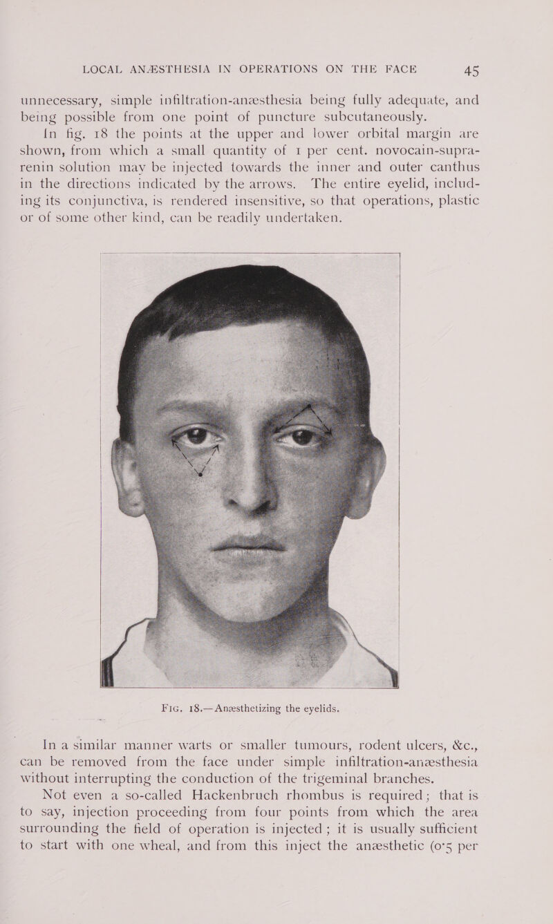 unnecessary, simple infiltration-anzesthesia being fully adequate, and being possible from one point of puncture subcutaneously. [In fig, 18 the points at the upper and lower orbital margin are shown, from which a small quantity of 1 per cent. novocain-supra- renin solution may be injected towards the inner and outer canthus in the directions indicated by the arrows. The entire eyelid, includ- ing its conjunctiva, is rendered insensitive, so that operations, plastic or of some other kind, can be readily undertaken. In a similar manner warts or smaller tumours, rodent ulcers, &amp;c., can be removed from the face under simple infiltration-anzesthesia without interrupting the conduction of the trigeminal branches. Not even a so-called Hackenbruch rhombus is required; that is to say, injection proceeding from four points from which the area surrounding the field of operation is injected; it is usually sufficient to start with one wheal, and from this inject the anzesthetic (0°5 per
