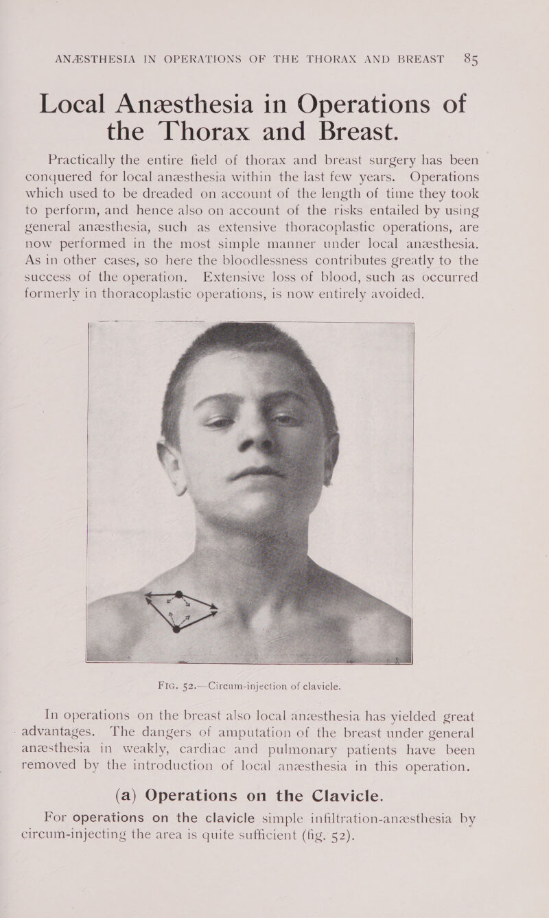 Local Anzesthesia in Operations of the Thorax and Breast. Practically the entire field of thorax and breast surgery has been conquered for local anzsthesia within the last few years. Operations which used to be dreaded on account of the length of time they took to perform, and hence also on account of the risks entailed by using general anesthesia, such as extensive thoracoplastic operations, are now performed in the most simple manner under local anzesthesia. As in other cases, so here the bloodlessness contributes greatly to the success OF the operation, Extensive loss of blood, such as occurred formerly in thoracoplastic operations, 1s now entirely avoided. In operations on the breast also local anzesthesia has yielded great -advantages. The dangers of amputation of the breast under general aneesthesia in weakly, cardiac and pulmonary patients have been removed by the introduction of local anzsthesia in this operation. (a) Operations on the Clavicle. For operations on the clavicle simple infiltration-anesthesia by circum-injecting the area is quite sufficient (fig. 52).