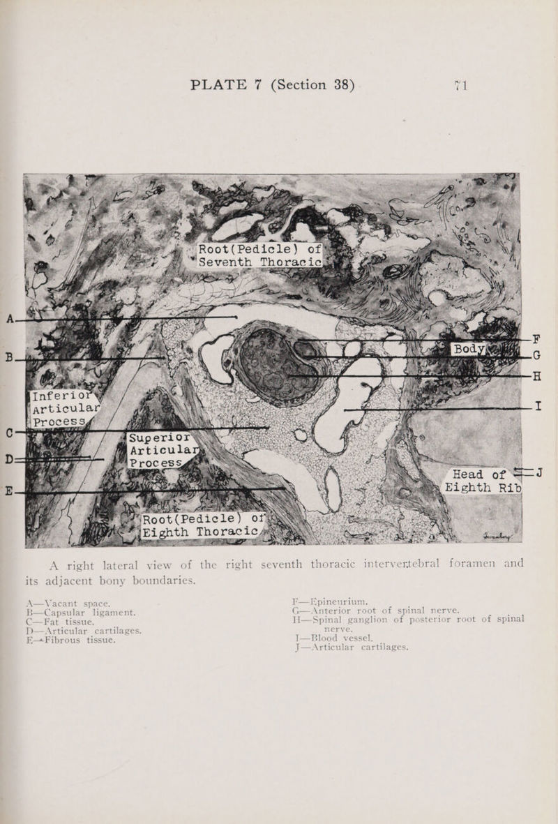 ie sat 4g Root(Pedicle) of yy, Seventh Thoracic ‘articular HProcess¢ AS) PORE © <a. PSPS . +s, | #Root(Pedicle) 0 ey wh Pe ee: Le ye he 7 rh Prvamhery: A right lateral view of the right seventh thoracic intervertebral foramen and its adjacent bony boundaries. A—Vacant space. F}—Epineurium. B—Capsular ligament. G—Anterior root of spinal nerve. C—Fat tissue. H—Spinal ganglion of posterior root of spinal D—Articular cartilages. nerve. E—Fibrous tissue. I—Blood vessel. J—Articular cartilages. J