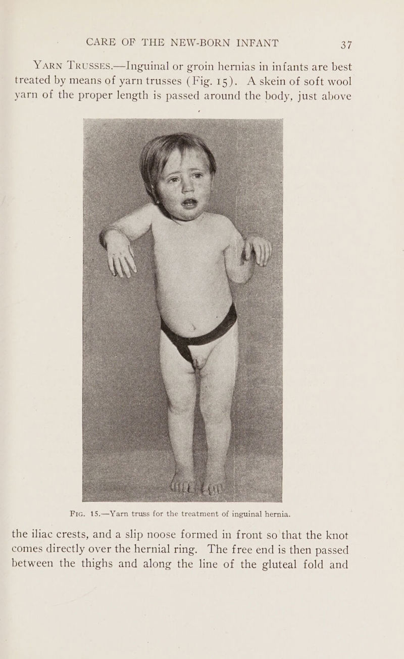 YARN TRusses.—Inguinal or groin hernias in infants are best treated by means of yarn trusses (Fig. 15). A skein of soft wool yarn of the proper length is passed around the body, just above Fic. 15.—yYarn truss for the treatment of inguinal hernia. the iliac crests, and a slip noose formed in front so that the knot comes directly over the hernial ring. The free end is then passed between the thighs and along the line of the gluteal fold and