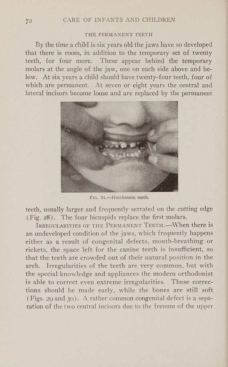 THE PERMANENT TEETH By the time a child is six years old the jaws have so developed that there is room, in addition to the temporary set of twenty teeth, for four more. Thesevappear behind the temporary molars at the angle of the jaw, one on each side above and be- low. At six years a child should have twenty-four teeth, four of which are permanent. At seven or eight years the central and lateral incisors become loose and are replaced by the permanent teeth, usually larger and frequently serrated on the cutting edge (Fig. 28). The four bicuspids replace the first molars. IRREGULARITIES OF TIE PERMANENT TEETH.—When there is an undeveloped condition of the jaws, which frequently happens either as a result of congenital defects, mouth-breathing or rickets, the space left for the canine teeth is insufficient, so that the teeth are crowded out of their natural position in the arch. Irregularities of the teeth are very common, but with the special knowledge and appliances the modern orthodonist is able to correct even extreme irregularities. ‘These correc- tions should be made early, while the bones are still soft (Figs. 29 and 30). A rather common congenital defect is a sepa- ration of the two central incisors due to the frenum of the upper