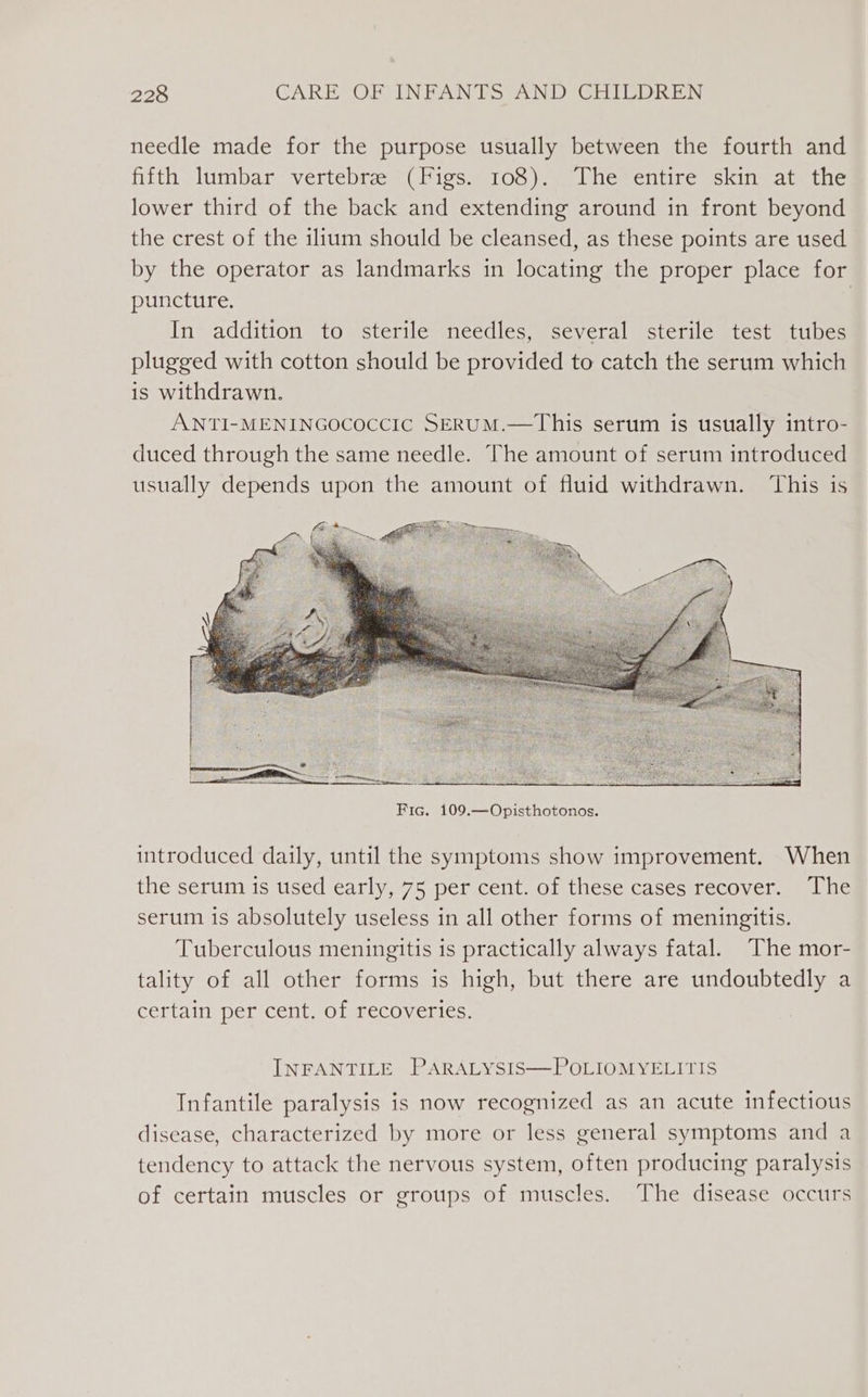 needle made for the purpose usually between the fourth and fifth lumbar vertebree ( Pigs. 108).) The entire skin at the lower third of the back and extending around in front beyond the crest of the ilium should be cleansed, as these points are used by the operator as landmarks in locating the proper place for puncture. | In addition to sterile needles, several sterile test tubes plugged with cotton should be provided to catch the serum which is withdrawn. ANTI-MENINGOCOCCIC SERUM.—This serum is usually intro- duced through the same needle. The amount of serum introduced usually depends upon the amount of fluid withdrawn. ‘This is introduced daily, until the symptoms show improvement. When the serum is used early, 75 per cent. of these cases recover. The serum is absolutely useless in all other forms of meningitis. Tuberculous meningitis is practically always fatal. The mor- tality of all other forms is high, but there are undoubtedly a certain per cent. of recoveries. INFANTILE PARALYSIS—POLIOMYELITIS Infantile paralysis is now recognized as an acute infectious disease, characterized by more or less general symptoms and a tendency to attack the nervous system, often producing paralysis of certain muscles or groups of muscles. The disease occurs