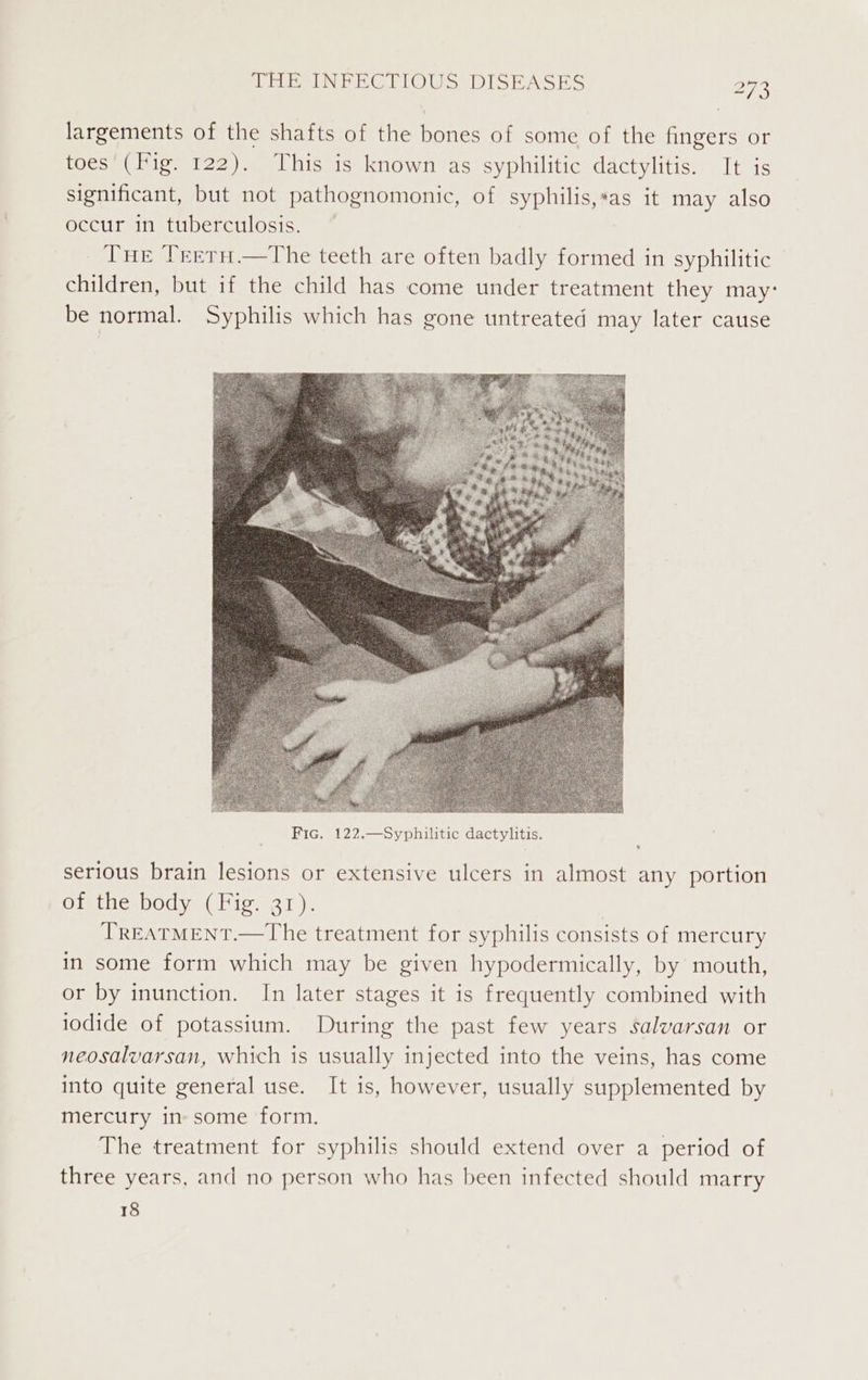 largements of the shafts of the bones of some of the fingers or toes’ (Fig. 122). This is known as syphilitic dactylitis. It is significant, but not pathognomonic, of syphilis,*as it may also occur in tuberculosis. Tue TreetH.—the teeth are often badly formed in syphilitic children, but if the child has come under treatment they may: be normal. Syphilis which has gone untreated may later cause serious brain lesions or extensive ulcers in almost any portion of the body (Fig. 31). TREATMENT.—The treatment for syphilis consists of mercury in some form which may be given hypodermically, by mouth, or by inunction. In later stages it is frequently combined with iodide of potassium. During the past few years salvarsan or neosalvarsan, which is usually injected into the veins, has come into quite general use. It is, however, usually supplemented by mercury in- some form. The treatment for syphilis should extend over a period of three years, and no person who has been infected should marry 8