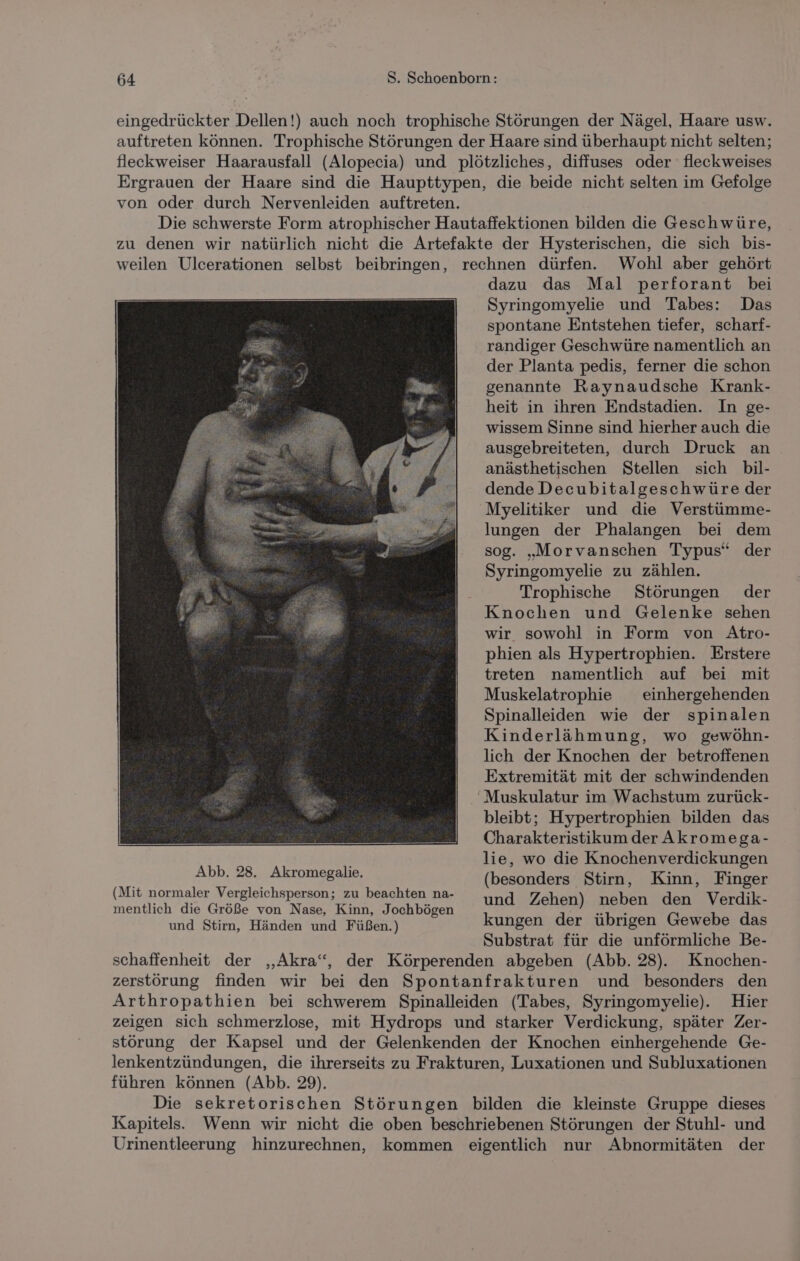 eingedrückter Dellen!) auch noch trophische Störungen der Nägel, Haare usw. auftreten können. Trophische Störungen der Haare sind überhaupt nicht selten; fleckweiser Haarausfall (Alopecia) und plötzliches, diffuses oder fleckweises Ergrauen der Haare sind die Haupttypen, die beide nicht selten im Gefolge von oder durch Nervenleiden auftreten. Die schwerste Form atrophischer Hautaffektionen bilden die Geschwüre, zu denen wir natürlich nicht die Artefakte der Hysterischen, die sich bis- weilen Ulcerationen selbst beibringen, rechnen dürfen. Wohl aber gehört dazu das Mal perforant bei Syringomyelie und Tabes: Das spontane Entstehen tiefer, scharf- randiger Geschwüre namentlich an der Planta pedis, ferner die schon genannte Raynaudsche Krank- heit in ihren Endstadien. In ge- wissem Sinne sind hierher auch die ausgebreiteten, durch Druck an anästhetischen Stellen sich bil- dende Decubitalgeschwüre der Myelitiker und die Verstümme- lungen der Phalangen bei dem sog. „Morvanschen Typus“ der Syringomyelie zu zählen. Trophische Störungen der Knochen und Gelenke sehen wir sowohl in Form von Atro- phien als Hypertrophien. Erstere treten namentlich auf bei mit Muskelatrophie einhergehenden Spinalleiden wie der spinalen Kinderlähmung, wo gewöhn- lich der Knochen der betroffenen Extremität mit der schwindenden Muskulatur im Wachstum zurück- bleibt; Hypertrophien bilden das Charakteristikum der Akromega- lie, wo die Knochenverdickungen Abb, BB. Akromegalie. (besonders Stirn, Kinn, Finger (Mit normaler Vergleichsperson; zu beachten na- und Zehen) neben den Verdik- mentlich die Größe von Nase, Kinn, Jochbögen IE WIE und Stirn, Händen und Füßen.) kungen der übrigen Gewebe das Substrat für die unförmliche Be- schaffenheit der ,„Akra“, der Körperenden abgeben (Abb. 28). Knochen- zerstörung finden wir bei den Spontanfrakturen und besonders den Arthropathien bei schwerem Spinalleiden (Tabes, Syringomyelie). Hier zeigen sich schmerzlose, mit Hydrops und starker Verdickung, später Zer- störung der Kapsel und der Gelenkenden der Knochen einhergehende Ge- lenkentzündungen, die ihrerseits zu Frakturen, Luxationen und Subluxationen führen können (Abb. 29). Die sekretorischen Störungen bilden die kleinste Gruppe dieses Kapitels. Wenn wir nicht die oben beschriebenen Störungen der Stuhl- und Urinentleerung hinzurechnen, kommen eigentlich nur Abnormitäten der