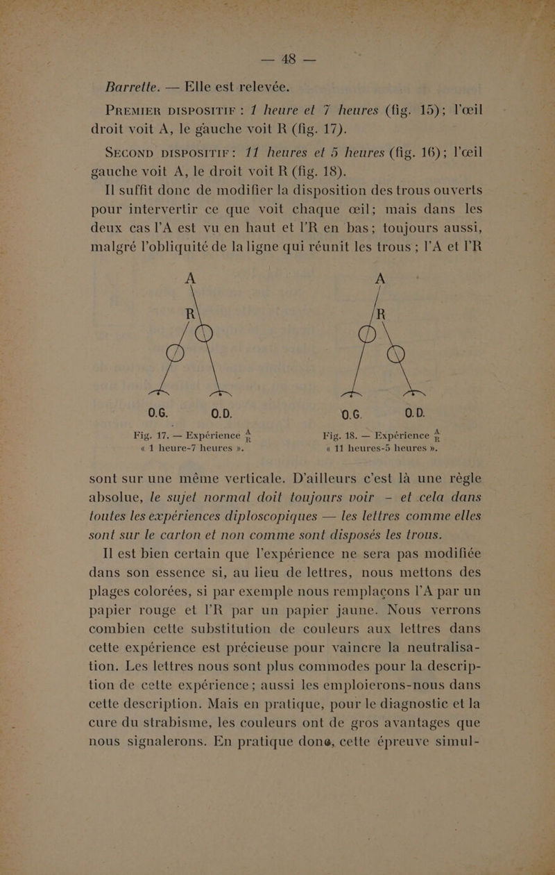 EE ae Eee Barrette. — Elle est relevée. PREMIER DISPOSITIF : 1 heure et 7 heures (fig. 15); l'œil droit voit À, le gauche voit R (fig. 17). SECOND DiSPOsiTiF: 11 heures et 5 heures (fig. 16); l'œil gauche voit À, le droit voit R (fig. 18). Il suffit donc de modifier la disposition des trous ouverts pour intervertir ce que voit chaque œil; mais dans les deux cas l'A est vu en haut et l’R en bas; toujours aussi, malgré l’obliquité de la ligne qui réunit les trous ; l'A et l’'R A A | À î 0.6 0.D 0.6 0.D LA x rte CE ss 22 A Fig. 17. — Expérience Fig. 18. — Expérience » « 1 heure-7 heures ». « 11 heures-5 heures ». sont sur une même verticale. D'ailleurs c'est là une règle absolue, le sujet normal doit toujours voir - et cela dans toutes les expériences diploscopiques — les lettres comme elles sont sur le carton et non comme sont disposés les trous. Il est bien certain que l'expérience ne sera pas modifiée dans son essence si, au lieu de lettres, nous mettons des plages colorées, si par exemple nous remplaçons l’Apar un papier rouge et l’R par un papier jaune. Nous verrons combien cette substitution de couleurs aux lettres dans cette expérience est précieuse pour vaincre la neutralisa- tion. Les lettres nous sont plus commodes pour la descrip- tion de cette expérience; aussi les emploierons-nous dans cette description. Mais en pratique, pour le diagnostic et la cure du strabisme, les couleurs ont de gros avantages que nous signalerons. En pratique done, cette épreuve simul-