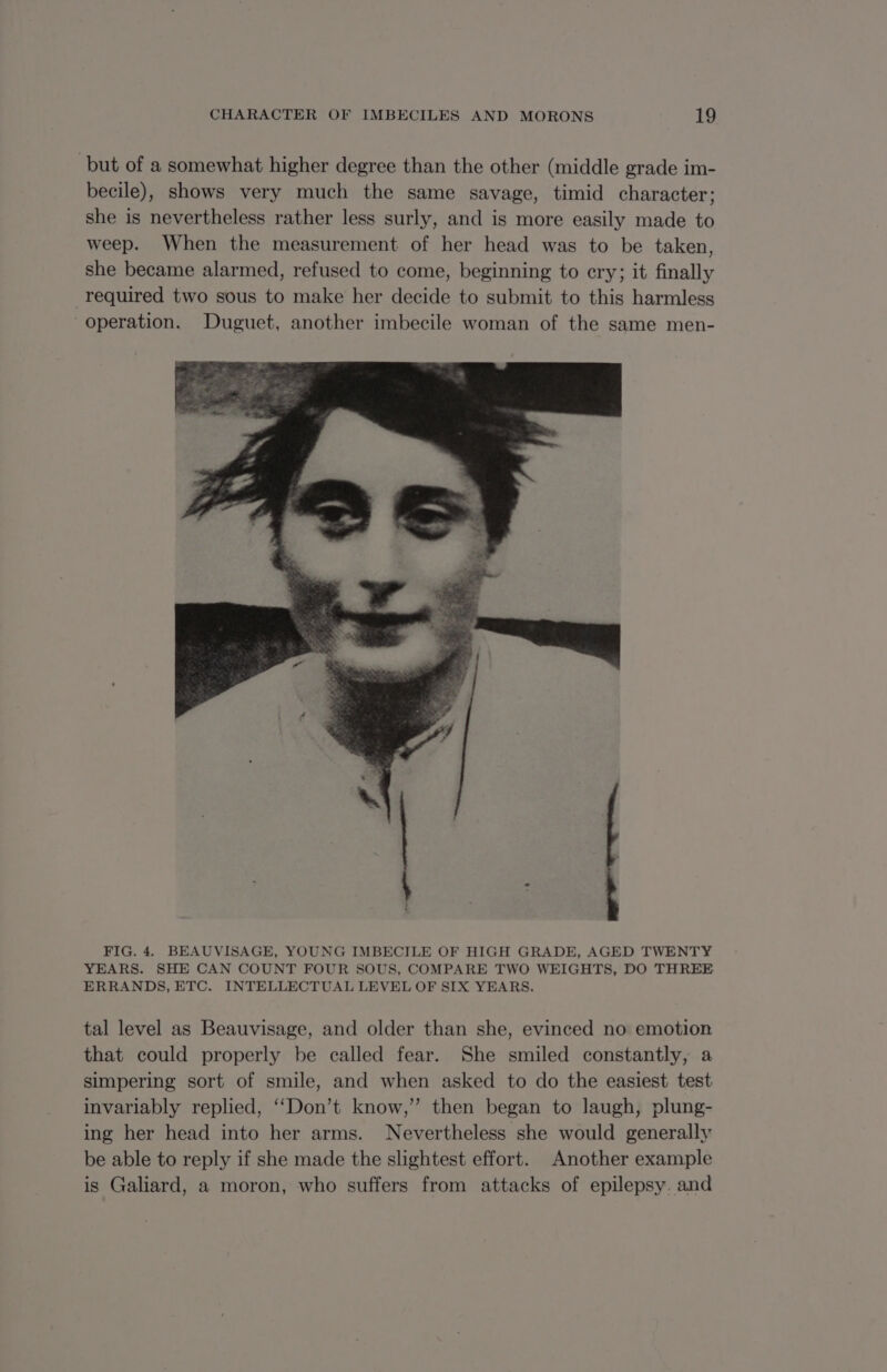 but of a somewhat higher degree than the other (middle grade im- becile), shows very much the same savage, timid character: she is nevertheless rather less surly, and is more easily made to weep. When the measurement of her head was to be taken, she became alarmed, refused to come, beginning to cry; it finally required two sous to make her decide to submit to this harmless operation. Duguet, another imbecile woman of the same men- FIG. 4. BEAUVISAGE, YOUNG IMBECILE OF HIGH GRADE, AGED TWENTY YEARS. SHE CAN COUNT FOUR SOUS, COMPARE TWO WEIGHTS, DO THREE ERRANDS, ETC. INTELLECTUAL LEVEL OF SIX YEARS. tal level as Beauvisage, and older than she, evinced no emotion that could properly be called fear. She smiled constantly, a simpering sort of smile, and when asked to do the easiest test invariably replied, ‘‘Don’t know,” then began to laugh, plung- ing her head into her arms. Nevertheless she would generally be able to reply if she made the slightest effort. Another example is Galiard, a moron, who suffers from attacks of epilepsy. and
