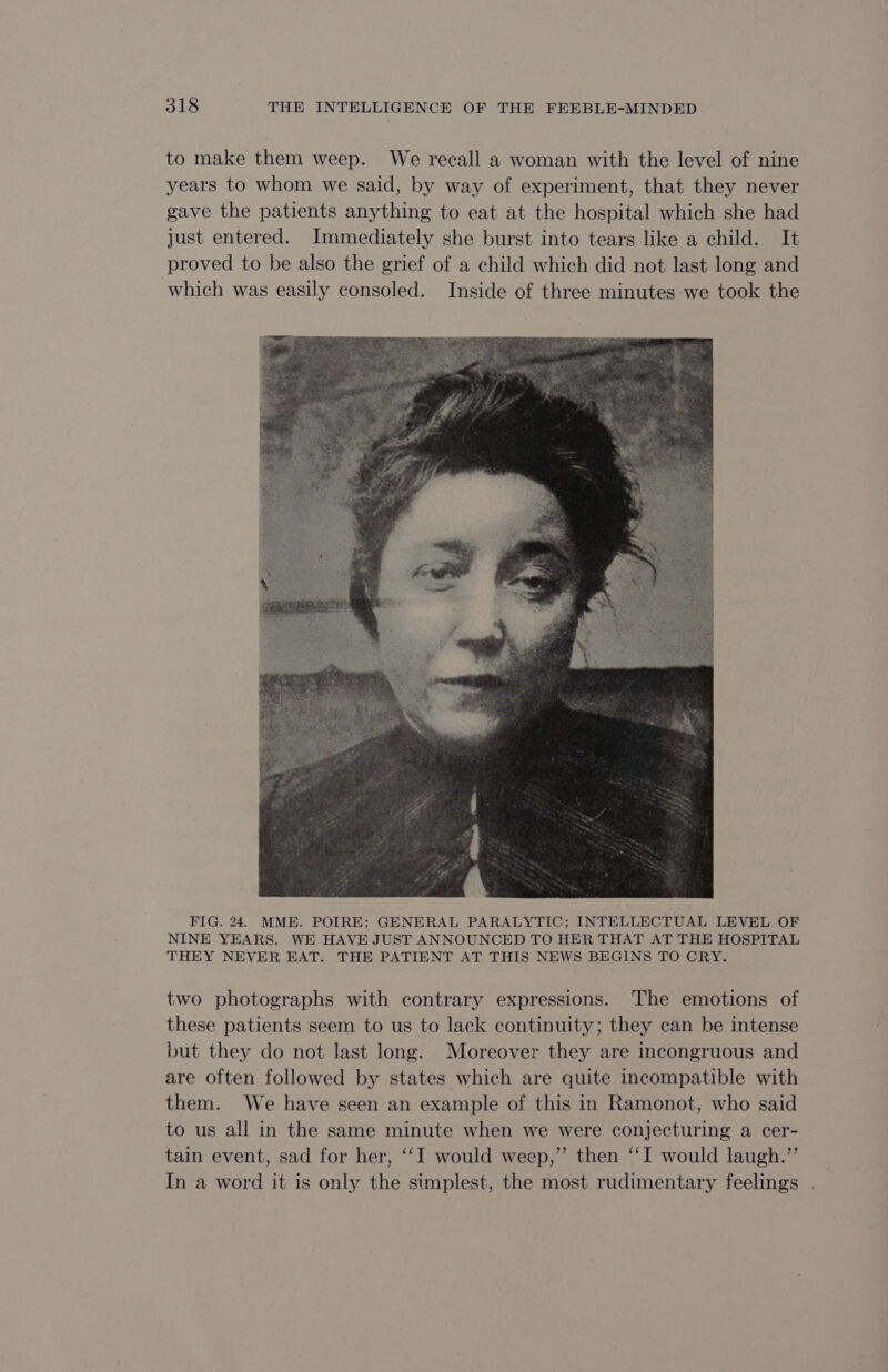to make them weep. We recall a woman with the level of nine years to whom we said, by way of experiment, that they never gave the patients anything to eat at the hospital which she had just entered. Immediately she burst into tears like a child. It proved to be also the grief of a child which did not last long and which was easily consoled. Inside of three minutes we took the FIG. 24. MME. POIRE; GENERAL PARALYTIC; INTELLECTUAL LEVEL OF NINE YEARS. WE HAVE JUST ANNOUNCED TO HER THAT AT THE HOSPITAL THEY NEVER EAT. THE PATIENT AT THIS NEWS BEGINS TO CRY. two photographs with contrary expressions. The emotions of these patients seem to us to lack continuity; they can be intense but they do not last long. Moreover they are incongruous and are often followed by states which are quite incompatible with them. We have seen an example of this in Ramonot, who said to us all in the same minute when we were conjecturing a cer- tain event, sad for her, ‘I would weep,” then “I would laugh.” In a word it is only the simplest, the most rudimentary feelings