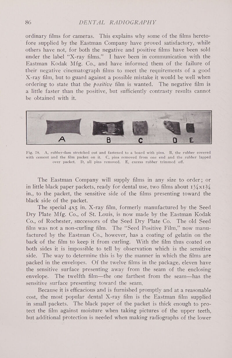 ordinary films for cameras. This explains why some of the films hereto- fore supplied by the Eastman Company have proved satisfactory, while others have not, for both the negative and positive films have been sold under the label “X-ray films.” I have been in communication with the Eastman Kodak Mfg. Co., and have informed them of the failure of their negative cinematograph films to meet the requirements of a good X-ray film, but to guard against a possible mistake it would be well when ordering to state that the positive film is wanted. The negative film is a little faster than the positive, but sufficiently contrasty results cannot be obtained with it. The Eastman Company will supply films in any size to order; or in little black paper packets, ready for dental use, two films about 114x134 in., to the packet, the sensitive side of the films presenting toward the black side of the packet. The special 4x5 in. X-ray film, formerly manufactured by the Seed Dry Plate Mfg. Co., of St. Louis, is now made by the Eastman Kodak Co., of Rochester, successors of the Seed Dry Plate Co. The old Seed film was not a non-curling film. The “Seed Positive Film,’ now manu- factured by the Eastman Co., however, has a coating of gelatin on the back of the film to keep it from curling. With the film thus coated on both sides it is impossible to tell by observation which is the sensitive side. The way to determine this is by the manner in which the films are packed in the envelopes. Of the twelve films in the package, eleven have the sensitive surface presenting away from the seam of the enclosing envelope. The twelfth film—the one farthest from the seam—has the sensitive surface presenting toward the seam, Because it is efficacious and is furnished promptly and at a reasonable cost, the most popular dental X-ray film is the Eastman film supplied in small packets. The black paper of the packet is thick enough to pro- tect the film against moisture when taking pictures of the upper teeth, but additional protection 1s needed when making radiographs of the lower