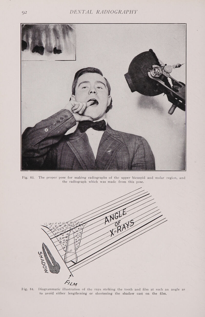 Fig. 83. The proper pose for making radiographs of the upper bicuspid and molar region, and the radiograph which was made from this pose. Hig. 84. Diagrammatic illustration of the rays striking the tooth and film at such an angle as to avoid either lengthening or shortening the shadow cast on the film.