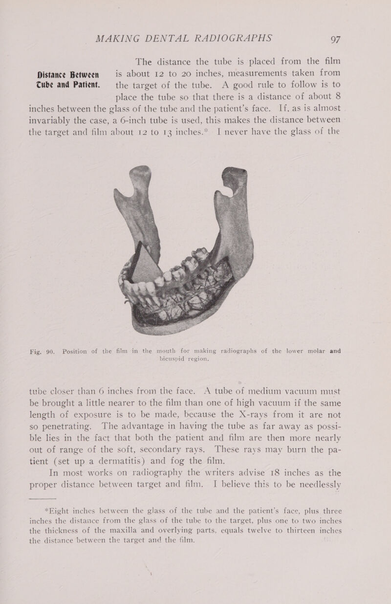 The distance the tube is placed from the film Distance Between is about 12 to 20 inches, measurements taken from Tube and Patient. the target of the tube. A good rule to follow is to place the tube so that there is a distance of about 8 inches between the glass of the tube and the patient’s face. If, as is almost invariably the case, a 6-inch tube is used, this makes the distance between - the target and film about 12 to 13 inches.* I never have the glass of the Fig. 90. Position of the film in the mouth for making radiographs of the lower molar and bicuspid region. tube closer than 6 inches from the face. A tube of medium vacuum must be brought a little nearer to the film than one of high vacuum if the same length of exposure is to be made, because the X-rays from it are not so penetrating. The advantage in having the tube as far away as possi- ble lies in the fact that both the patient and film are then more nearly out of range of the soft, secondary rays. These rays may burn the pa- tient (set up a dermatitis) and fog the film. | In most works on radiography the writers advise 18 inches as the proper distance between target and film. I believe this to be needlessly *ERight inches between the glass of the tube and the patient’s face, plus three inches the distance from the glass of the tube to the target, plus one to two inches the thickness of the maxilla and overlying parts, equals twelve to thirteen inches the distance between the target and the film. !