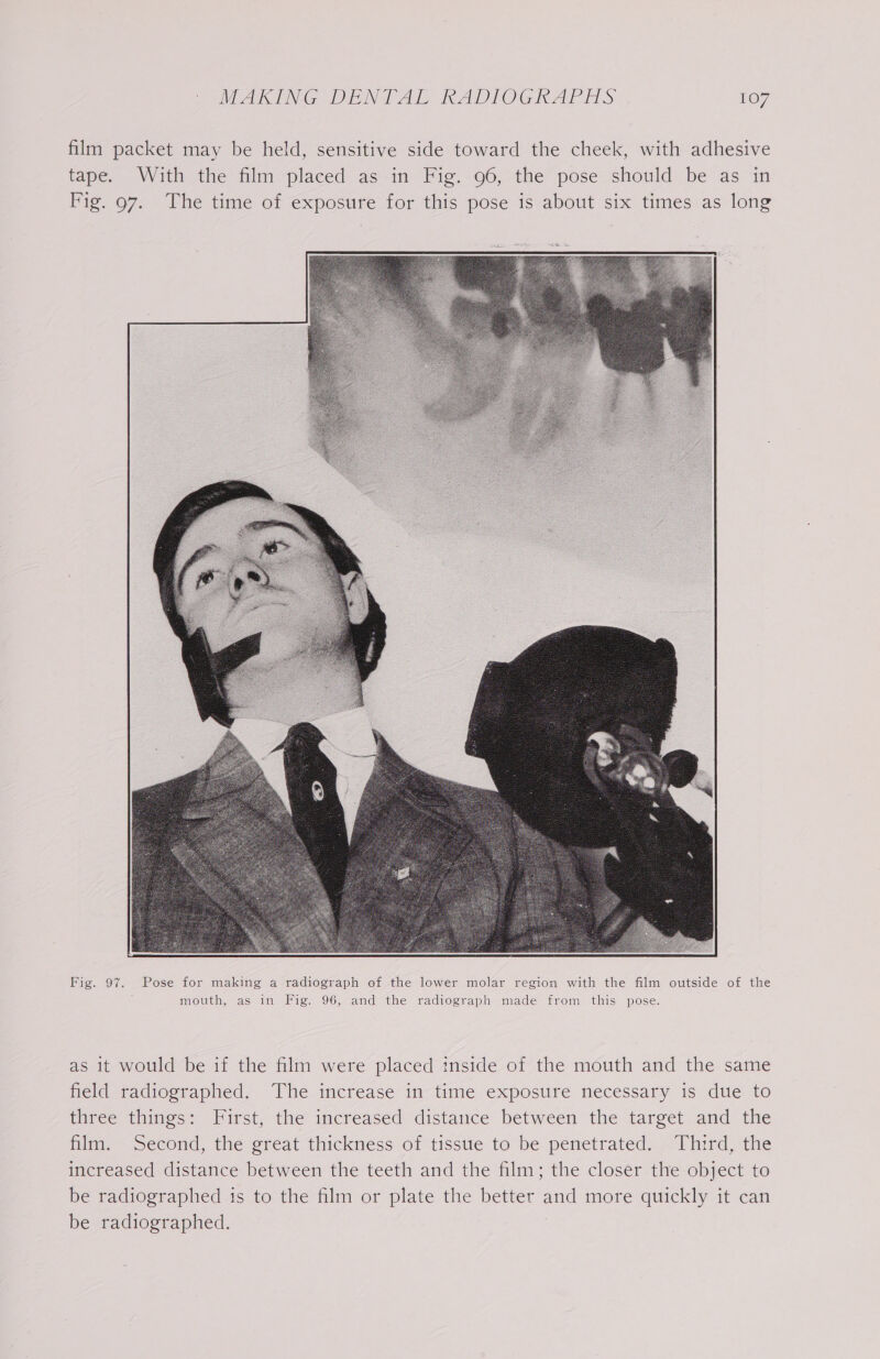 film packet may be held, sensitive side toward the cheek, with adhesive tape. With the film placed as in Fig. 96, the pose should be as in Fig. 97. The time of exposure for this pose is about six times as long Fig. 97. Pose for making a radiograph of the lower molar region with the film outside of the mouth, as in Fig. 96, and the radiograph made from this pose. as it would be if the film were placed inside of the mouth and the same field radiographed. The increase in time exposure necessary is due to three things: First, the increased distance between the target and the film. Second, the great thickness of tissue to be penetrated. —Third, the increased distance between the teeth and the film; the closer the object to be radiographed is to the film or plate the better and more quickly it can be radiographed.