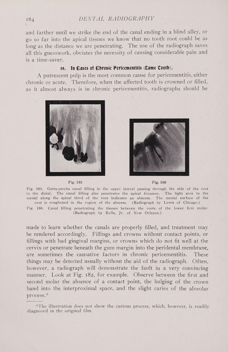 and farther until we strike the end of the canal ending in a blind alley, or go so far into the apical tissues we know that no tooth root could be as long as the distance we are penetrating. The use of the radiograph saves all this guesswork, obviates the necessity of causing considerable pain and is a time-saver. 19. Tn Cases of Chronic Pericementitis (Lame Cooth). A putrescent pulp is the most common cause for pericementitis, either chronic or acute. Therefore, when the affected tooth is crowned or filled, as it almost always is in chronic pericementitis, radiographs should be Fig. 185 Fig. 186 Fig. 185. Gutta-percha canal filling in the upper lateral passing through the side of the root to the distal. The canal filling also penetrates the apical foramen. The light area to the mesial along the apical third of the root indicates an abscess. The mesial surface of the root is roughened in the region of the abscess. (Radiograph by Lewis of Chicago.) Fig. 186. Canal filling penetrating the tissues between the roots of the lower first molar. (Radiograph by Kells, Jr. of New Orleans.) made to learn whether the canals are properly filled, and treatment may be rendered accordingly. Fillings and crowns without contact points, or fillings with bad gingival margins, or crowns which do not fit well at the cervix or penetrate beneath the gum margin into the peridental membrane, are sometimes the causative factors in chronic pericementitis. These things may be detected usually without the aid of the radiograph. Often, however, a radiograph will demonstrate the fault in a very convincing manner. Look at Fig: 182, for example. Observe between the first and second molar the absence of a contact point, the bulging of the crown band into the interproximal space, and the slight caries of the alveolar process.* *The illustration does not show the carious process, which, however, is readily diagnosed in the original film.