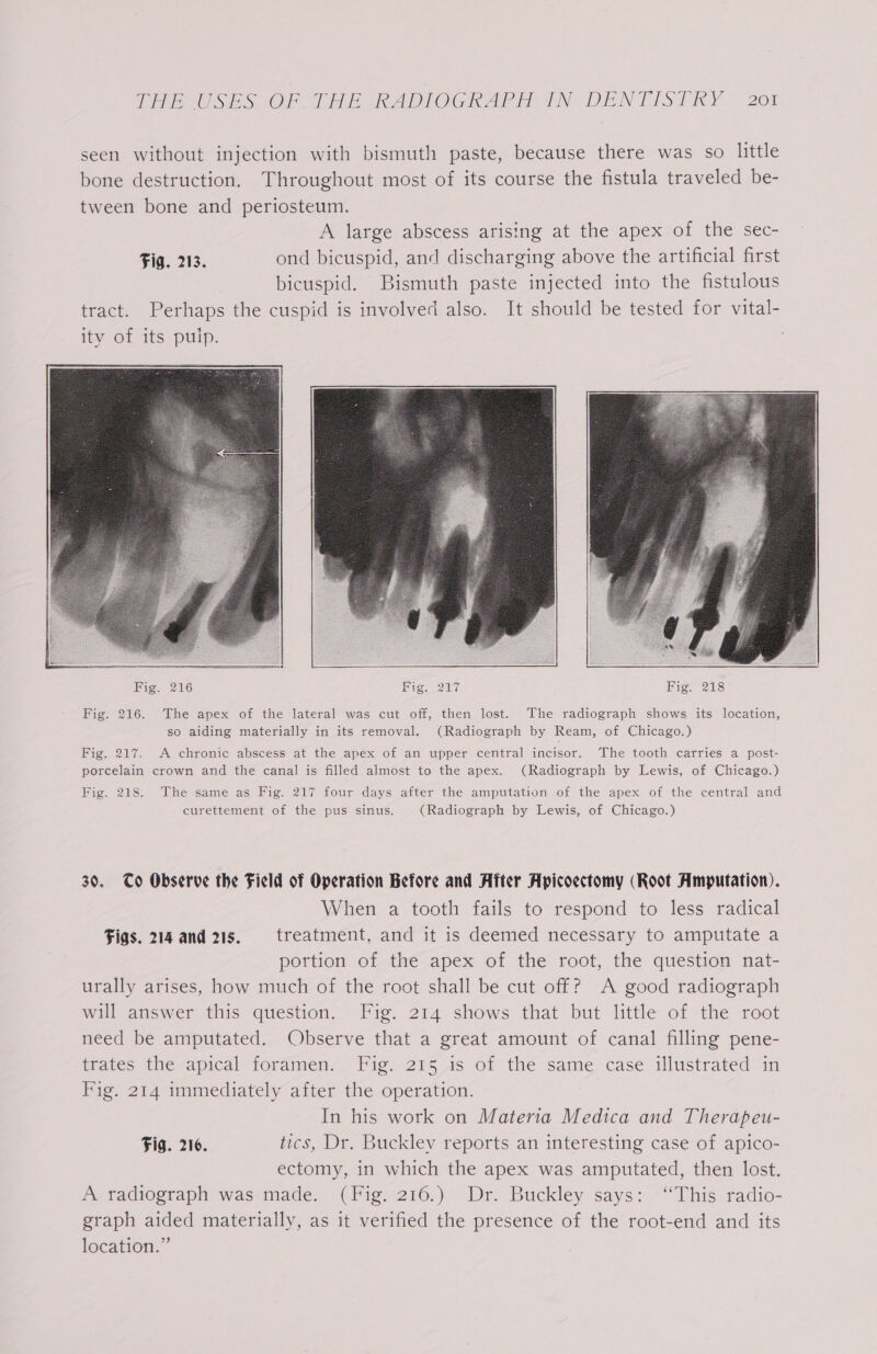 seen without injection with bismuth paste, because there was so little bone destruction. Throughout most of its course the fistula traveled be- tween bone and periosteum. A large abscess arising at the apex of the sec- Fig. 213. ond bicuspid, and discharging above the artificial first bicuspid. Bismuth paste injected into the fistulous tract. Perhaps the cuspid is involved also. It should be tested for vital- ity of its puip. Fig. 216. The apex of the lateral was cut off, then lost. The radiograph shows its location, so aiding materially in its removal. (Radiograph by Ream, of Chicago.) Fig. 217. A chronic abscess at the apex of an upper central incisor. The tooth carries a post- porcelain crown and the canal is filled almost to the apex. (Radiograph by Lewis, of Chicago.) Fig. 218. The same as Pig. 217 four days after the amputation .of the apex of the central and curettement of the pus sinus. (Radiograph by Lewis, of Chicago.) 30. To Observe the Field of Operation Before and After Apicoectomy (Root Amputation). When a tooth fails to respond to less radical Figs. 214 and 215. treatment, and it is deemed necessary to amputate a portion of the apex of the root, the question nat- urally arises, how much of the root shall be cut off? A good radiograph will answer this question. Fig. 214 shows that but little of the root need be amputated. Observe that a great amount of canal filling pene- trates the apical foramen. Fig. 215 1s of the same case illustrated in Fig. 214 immediately after the operation. In his work on Materia Medica and Therapeu- Fig. 216. tics, Dr. Buckley reports an interesting case of apico- ectomy, in which the apex was amputated, then lost. A radiograph was made. (Fig. 216.) Dr. Buckley says: ‘This radio- graph aided materially, as it verified the presence of the root-end and its location.”