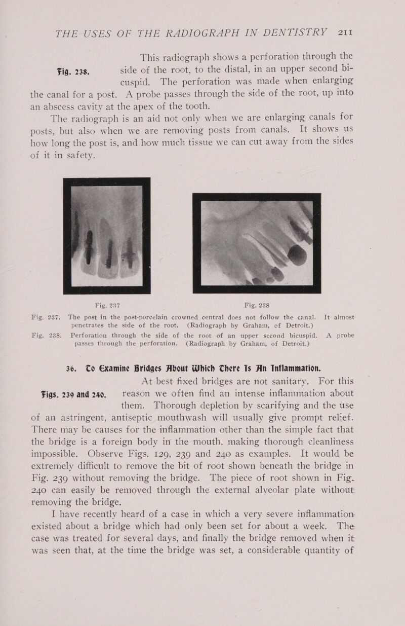 This radiograph shows a perforation through the Fig. 238. side of the root, to the distal, in an upper second bi- cuspid. The perforation was made when enlarging the canal for a post. A probe passes through the side of the root, up into an abscess cavity at the apex of the tooth. The radiograph is an aid not only when we are enlarging canals for posts, but also when we are removing posts from canals. It shows us how long the post is, and how much tissue we can cut away from the sides of it in safety. Fig. 237. The post in the post-porcelain crowned central does not follow the canal. It almost penetrates the side of the root. (Radiograph by Graham, cf Detroit.) Fig. 238. Perforation through the side of the root of an upper second bicuspid. A probe passes through the perforation. (Radiograph by Graham, of Detroit.) 36. Co Examine Bridges About Which Chere Is An Inflammation. At best fixed bridges are not sanitary. For this Figs. 239 and 240, reason we often find an intense inflammation about them. Thorough depletion by scarifying and the use of an astringent, antiseptic mouthwash will usually give prompt relief. There may be causes for the inflammation other than the simple fact that the bridge is a foreign body in the mouth, making thorough cleanliness impossible. Observe Figs. 129, 239 and 240 as examples. It would be extremely difficult to remove the bit of root shown beneath the bridge in Fig. 239 without removing the bridge. The piece of root shown in Fig. 240 can easily be removed through the external alveolar plate without removing the bridge. I have recently heard of a case in which a very severe inflammation existed about a bridge which had only been set for about a week. The case was treated for several days, and finally the bridge removed when it was seen that, at the time the bridge was set, a considerable quantity of