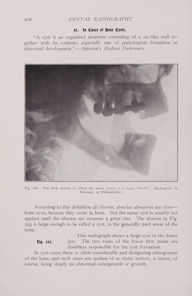 42, In Gases of Bone Cysts. “A ‘cyst is an organized structure consisting of a sac-like wall to- gether with its contents, especially one of pathological formation or abnormal development.”—Appleton’s Medical Dictionary. According to this definition all chronic alveolar abscesses are cysts— bone cysts, because they occur in bone. But the name cyst is usually not applied until the abscess sac assumes a great size. The abscess in Fig. 193 is large enough to be called a cyst, in the generally used sense of the term. This radiograph shows a large cyst in the lower Fig. 252. jaw. The two roots of the lower first molar are doubtless responsible for the cyst formation. In cyst cases there is often considerable and disfiguring enlargement of the bone, and such cases are spoken of as cystic tumors, a tumor, of course, being simply an abnormal enlargement or growth.