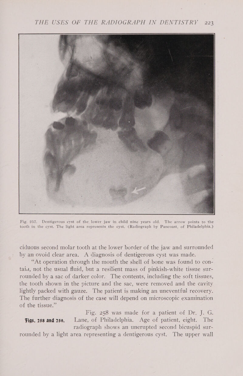 PREV USES Oe Fak RADIOGRAPH IN DENTISTRY. 222 ciduous second molar tooth at the lower border of the jaw and surrounded by an ovoid clear area. A diagnosis of dentigerous cyst was made. “At operation through the mouth the shell of bone was found to con- taint, not the usual fluid, but a resilient mass of pinkish-white tissue sur- rounded by a sac of darker color. The contents, including the soft tissues, the tooth shown in the picture and the sac, were removed and the cavity lightly packed with gauze. The patient is making an uneventful recovery. The further diagnosis of the case will depend on microscopic examination of the tissue.” ioe 2236 was made tor a patient or Dre G. Figs. 258 and 259, Lane, of Philadelphia. Age of patient, eight. The radiograph shows an unerupted second bicuspid sur- rounded by a light area representing a dentigerous cyst. The upper wall