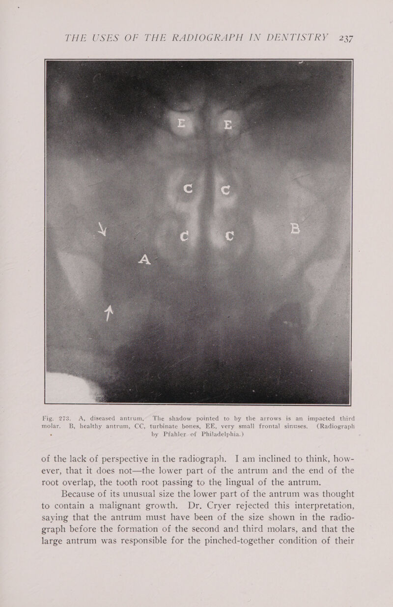 Fig. 273. &lt;A, diseased antrum, The shadow pointed to by the arrows is an impacted third molar. B, healthy antrum, CC, turbinate bones, EE, very small frontal sinuses. (Radiograph ° by Pfahler of Philadelphia.) of the lack of perspective in the radiograph. I am inclined to think, how- ever, that it does not—the lower part of the antrum and the end of the root overlap, the tooth root passing to the lingual of the antrum. Because of its unusual size the lower part of the antrum was thought to contain a malignant growth. Dr. Cryer rejected this interpretation, saying that the antrum must have been of the size shown in the radio- graph before the formation of the second and third molars, and that the large antrum was responsible for the pinched-together condition of their