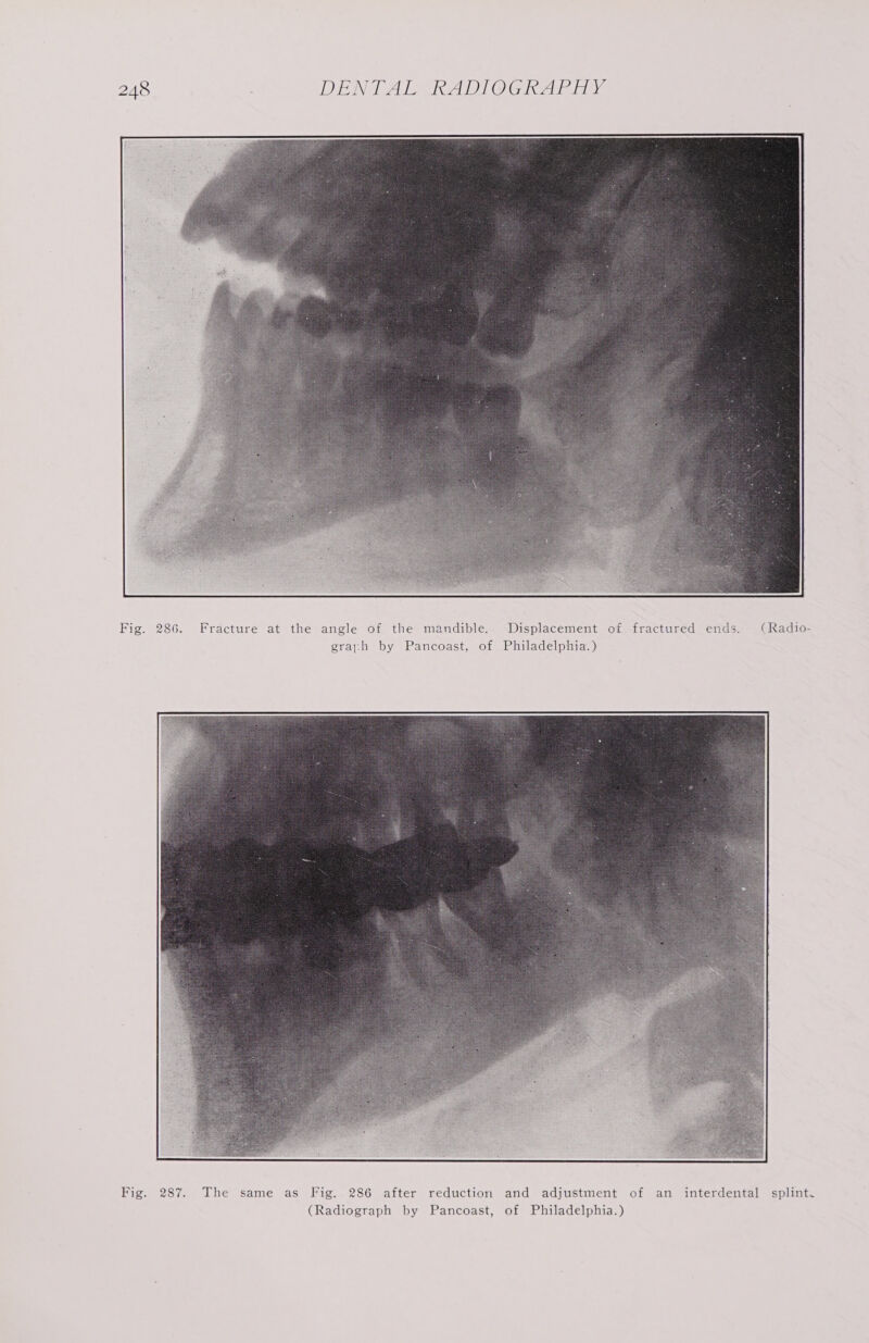 Fig. 286. Fracture at the angle of the mandible. Displacement of fractured ends. (Radio- graph by Pancoast, of Philadelphia.) Fig. 287. The same as Fig. 286 after reduction and adjustment of an interdental splint. (Radiograph by Pancoast, of Philadelphia.)