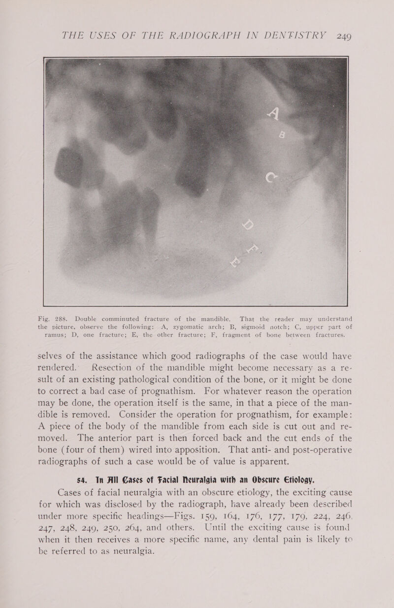 Fig. 288. Double comminuted fracture of the mandible. That the reader may understand the picture, observe the following: A, zygomatic arch; B, sigmoid notch; C, upper part of ramus; D, one fracture; E, the other fracture; F, fragment of bone between fractures. selves of the assistance which good radiographs of the case would have rendered.. Resection of the mandible might become necessary as a re- sult of an existing pathological condition of the bone, or it might be done to correct a bad case of prognathism. For whatever reason the operation may be done, the operation itself is the same, in that a piece of the man- dible is removed. Consider the operation for prognathism, for example: A piece of the body of the mandible from each side is cut out and re- moved. The anterior part is then forced back and the cut ends of the bone (four of them) wired into apposition. That anti- and post-operative radiographs of such a case would be of value is apparent. 54. Tn All Gases of Facial Neuralgia with an Obscure Etiology. Cases of facial neuralgia with an obscure etiology, the exciting cause for which was disclosed by the radiograph, have already been described under more specific headings—Figs. 159, 164, 176, 177, 179, 224, 246, ZA7 243240, 20.204, and others. Until the exciting cause is found when it then receives a more specific name, any dental pain is likely to be referred to as neuralgia.