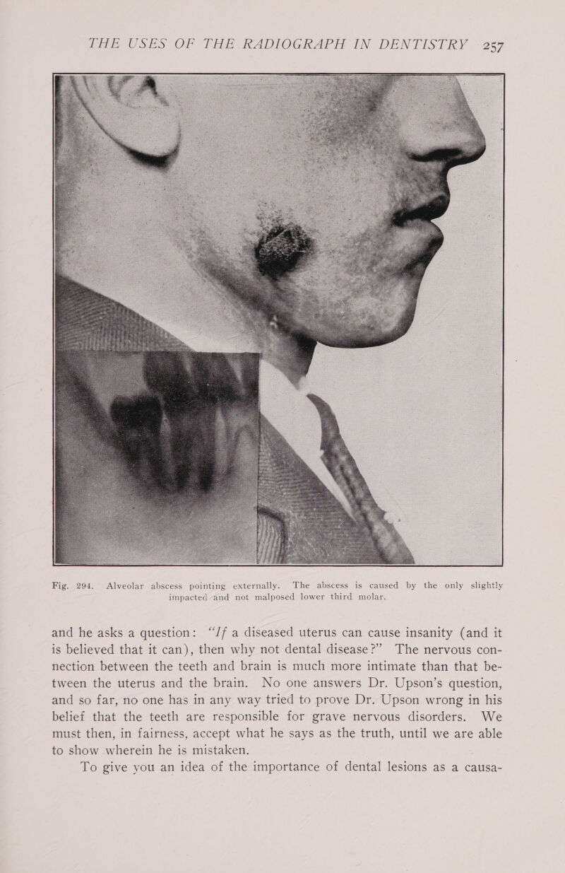 CE USES OF fie RADIOGRArE IN DENTISTRY ~ 267 and he asks a question: “J/f a diseased uterus can cause insanity (and it is believed that it can), then why not dental disease?’ The nervous con- nection between the teeth and brain is much more intimate than that be- tween the uterus and the brain. No one answers Dr. Upson’s question, and so far, no one has in any way tried to prove Dr. Upson wrong in his belief that the teeth are responsible for grave nervous disorders. We must then, in fairness, accept what he says as the truth, until we are able to show wherein he is mistaken. | To give you an idea of the importance of dental lesions as a causa-