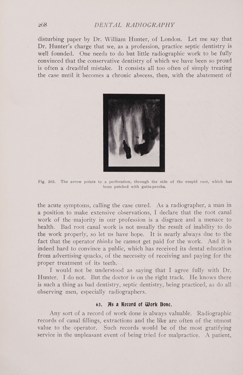 disturbing paper by Dr. William Hunter, of London. Let me say that Dr. Hunter’s charge that we, as a profession, practice septic dentistry is well founded. One needs to do but little radiographic work to be fully convinced that the conservative dentistry of which we have been so proud is often a dreadful mistake. It consists all too often of simply treating the case until it becomes a chronic abscess, then, with the abatement of Fig. 305. The arrow points to a perforation, through the side of the cuspid root, which has been patched with gutta-percha. the acute symptoms, calling the case cured. As a radiographer, a man in a position to make extensive observations, I declare that the root canal work of the majority in our profession is a disgrace and a menace to health. Bad root canal work is not usually the result of inability to do the work properly, so let us have hope. It is nearly always due to the fact that the operator thinks he cannot get paid for the work. And it is indeed hard to convince a public, which has received its dental education from advertising quacks, of the necessity of receiving and paying for the proper treatment of its teeth. I would not be understood as saying that I agree fully with Dr. Hunter. I donot. But the doctor is on the right track. He knows there is such a thing as bad dentistry, septic dentistry, being practiced, as do all observing men, especially radiographers. 63. As a Record of Work Done. Any sort of a record of work done is always valuable. Radiographic records of canal fillings, extractions and the like are often of the utmost value to the operator. Such records would be of the most gratifying service in the unpleasant event of being tried for malpractice. A patient,