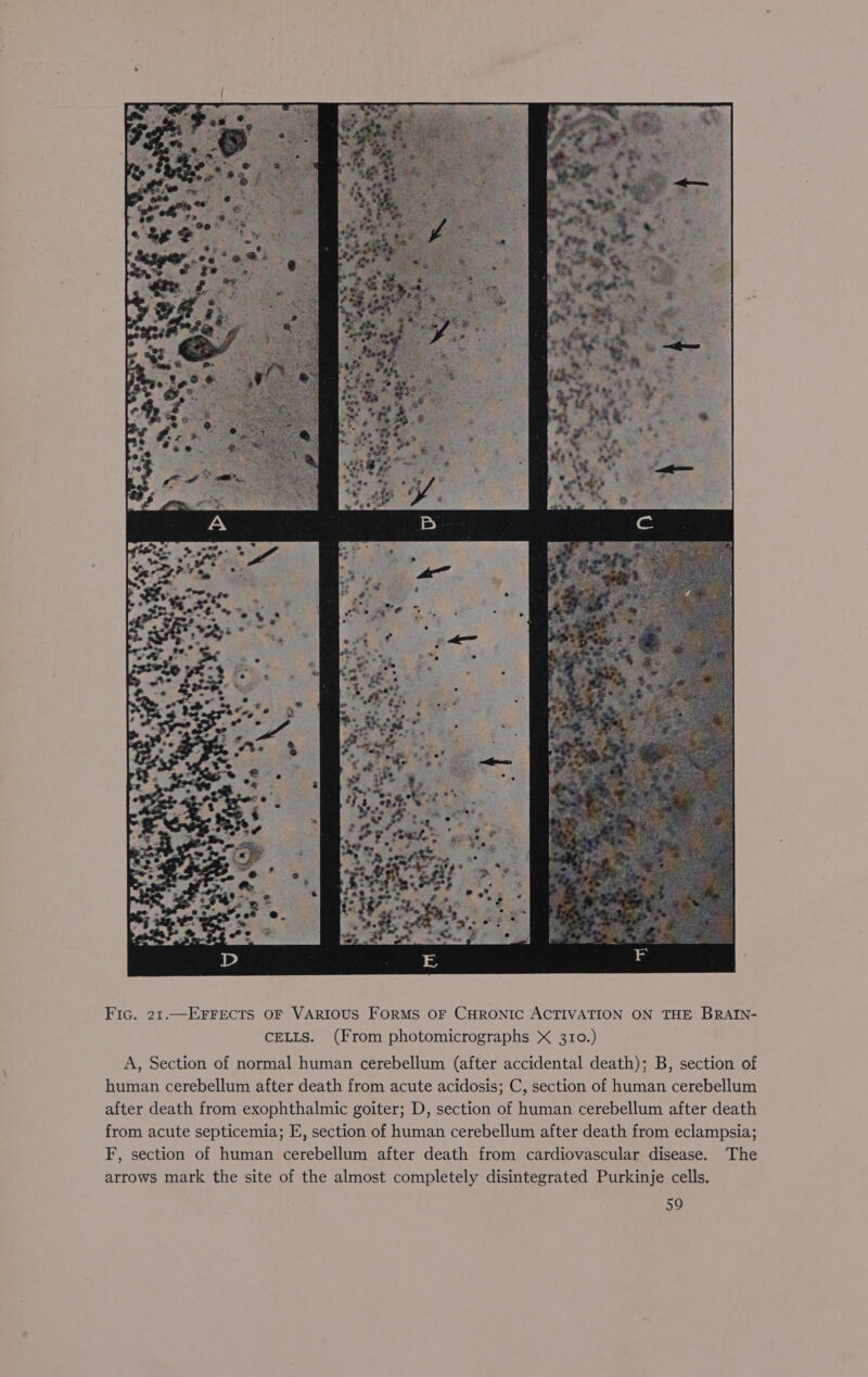 Fic. 21.—EFFECTS OF VARIOUS FoRMS OF CHRONIC ACTIVATION ON THE BRAIN- CELLS. (From photomicrographs X 310.) A, Section of normal human cerebellum (after accidental death); B, section of human cerebellum after death from acute acidosis; C, section of human cerebellum after death from exophthalmic goiter; D, section of human cerebellum after death from acute septicemia; E, section of human cerebellum after death from eclampsia; F, section of human cerebellum after death from cardiovascular disease. The arrows mark the site of the almost completely disintegrated Purkinje cells.