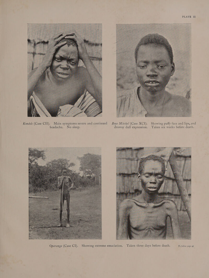 PLATES TE - Kondolo (Case CII). Main symptoms severe and continued Boyo Mitchel (Case XCI). Showing puffy face and lips, and headache. No sleep. drowsy dull expression. ‘Taken six weeks before death.