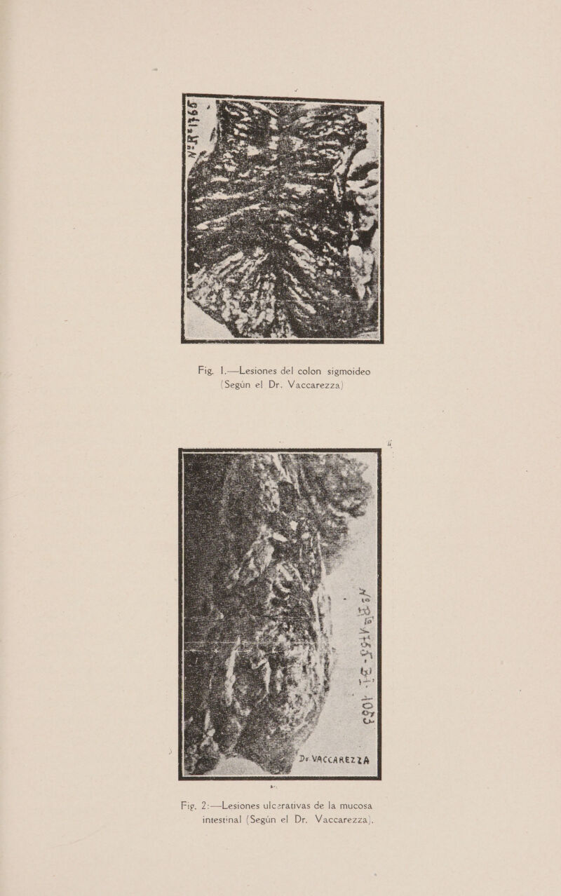 Fig. 1.—Lesiones del colon sigmoideo (Según el Dr. Vaccarezza) intestinal (Según el Dr. WVaccarezza).