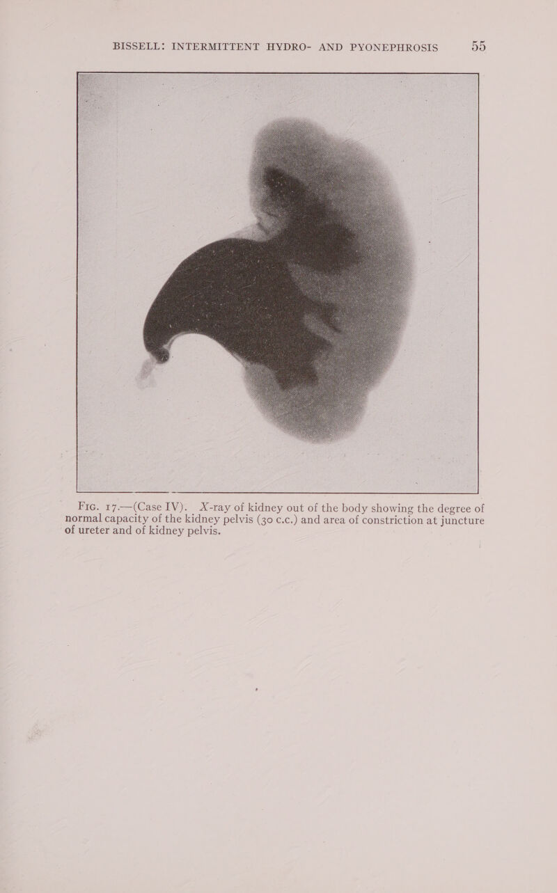 Fic. 17.—(Case IV). X-ray of kidney out of the body showing the degree of normal capacity of the kidney pelvis (30 c.c.) and area of constriction at juncture of ureter and of kidney pelvis.