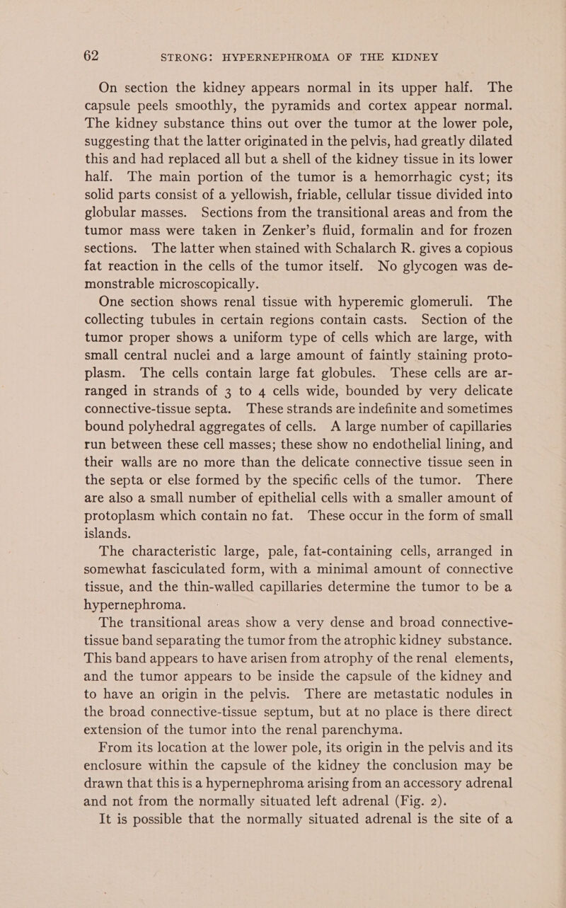 On section the kidney appears normal in its upper half. The capsule peels smoothly, the pyramids and cortex appear normal. The kidney substance thins out over the tumor at the lower pole, suggesting that the latter originated in the pelvis, had greatly dilated this and had replaced all but a shell of the kidney tissue in its lower half. The main portion of the tumor is a hemorrhagic cyst; its solid parts consist of a yellowish, friable, cellular tissue divided into globular masses. Sections from the transitional areas and from the tumor mass were taken in Zenker’s fluid, formalin and for frozen sections. The latter when stained with Schalarch R. gives a copious fat reaction in the cells of the tumor itself. No glycogen was de- monstrable microscopically. One section shows renal tissue with hyperemic glomeruli. The collecting tubules in certain regions contain casts. Section of the tumor proper shows a uniform type of cells which are large, with small central nuclei and a large amount of faintly staining proto- plasm. The cells contain large fat globules. These cells are ar- ranged in strands of 3 to 4 cells wide, bounded by very delicate connective-tissue septa. These strands are indefinite and sometimes bound polyhedral aggregates of cells. A large number of capillaries run between these cell masses; these show no endothelial lining, and their walls are no more than the delicate connective tissue seen in the septa or else formed by the specific cells of the tumor. There are also a small number of epithelial cells with a smaller amount of protoplasm which contain no fat. These occur in the form of small islands. The characteristic large, pale, fat-containing cells, arranged in somewhat fasciculated form, with a minimal amount of connective tissue, and the thin-walled capillaries determine the tumor to be a hypernephroma. The transitional areas show a very dense and broad connective- tissue band separating the tumor from the atrophic kidney substance. This band appears to have arisen from atrophy of the renal elements, and the tumor appears to be inside the capsule of the kidney and to have an origin in the pelvis. There are metastatic nodules in the broad connective-tissue septum, but at no place is there direct extension of the tumor into the renal parenchyma. From its location at the lower pole, its origin in the pelvis and its enclosure within the capsule of the kidney the conclusion may be drawn that this is a hypernephroma arising from an accessory adrenal and not from the normally situated left adrenal (Fig. 2). It is possible that the normally situated adrenal is the site of a