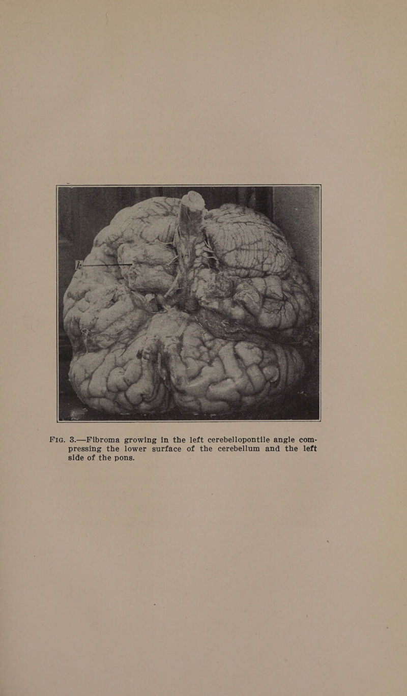 Fig. 3.—Fibroma growing in the left cerebellopontile angle com- pressing the lower surface of the cerebellum and the left side of the pons.