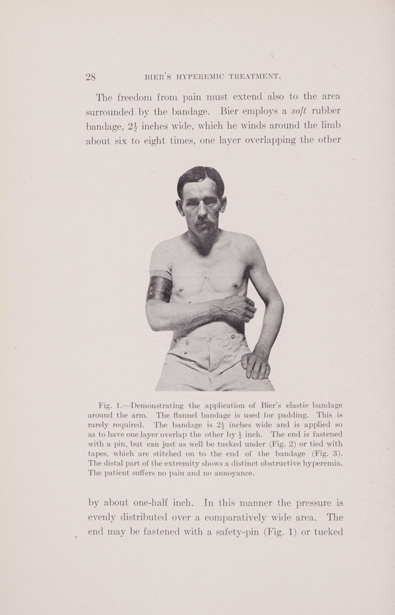 The freedom from pain must extend also to the area surrounded by the bandage. Bier employs a soft rubber bandage, 24 inches wide, which he winds around the limb about six to eight times, one layer overlapping the other Fig. 1—Demonstrating the application of Bier’s elastic bandage around the arm. The flannel bandage is used for padding. This is rarely required. The bandage is 24 inches wide and is applied so as to have one layer overlap the other by 4 inch. The end is fastened with a pin, but can just as well be tucked under (Fig. 2) or tied with tapes, which are stitched on to the end of the bandage (Fig. 3). The distal part of the extremity shows a distinct obstructive hyperemia. The patient suffers no pain and no annoyance. by about one-half inch. In this manner the pressure is evenly distributed over a comparatively wide area. The end may be fastened with a safety-pin (Fig. 1) or tucked