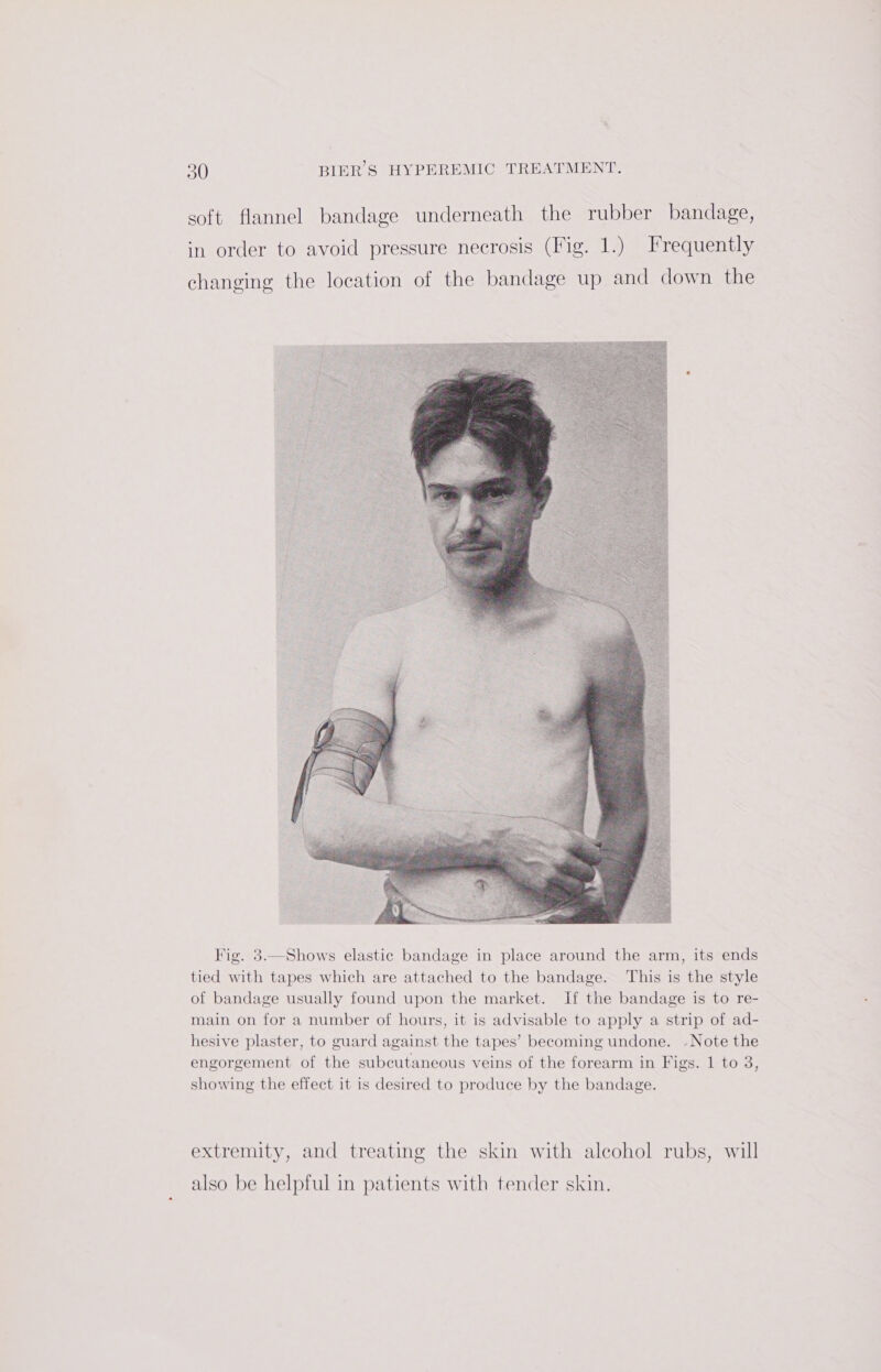 soft flannel bandage underneath the rubber bandage, in order to avoid pressure necrosis (Fig. 1.) Frequently changing the location of the bandage up and down the Fig. 3.—Shows elastic bandage in place around the arm, its ends tied with tapes which are attached to the bandage. This is the style of bandage usually found upon the market. If the bandage is to re- main on for a number of hours, it is advisable to apply a strip of ad- hesive plaster, to guard against the tapes’ becoming undone. - Note the engorgement of the subcutaneous veins of the forearm in Figs. 1 to 3, showing the effect it is desired to produce by the bandage. extremity, and treating the skin with alcohol rubs, will also be helpful in patients with tender skin.